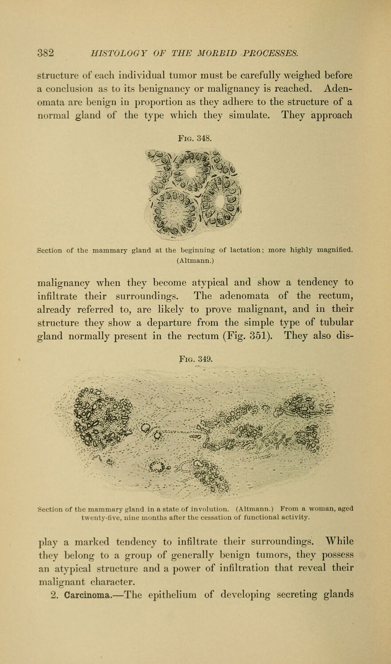 structure of each individual tumor must be carefully weighed before a conclusion as to its benignancy or malignancy is reached. Aden- omata are benign in proportion as they adhere to the structure of a normal gland of the type which they simulate. They approach Fig. 348. Section of the mammary gland at the beginning of lactation; more highly magnified. (Altmann.) malignancy when they become atypical and show a tendency to infiltrate their surroundings. The adenomata of the rectum, already referred to, are likely to prove malignant, and in their structure they show a departure from the simple type of tubular gland normally present in the rectum (Fig. 351). They also dis- FiG. 349. Section of the mammary gland in a state of involution. (Altmann.) From a woman, aged twenty-live, nine months after the cessation of functional activity. play a marked tendency to infiltrate their surroundings. While they belong to a group of generally benign tumors, they possess an atypical structure and a power of infiltration that reveal their malignant character. 2. Carcinoma.—The epithelium of developing secreting glands
