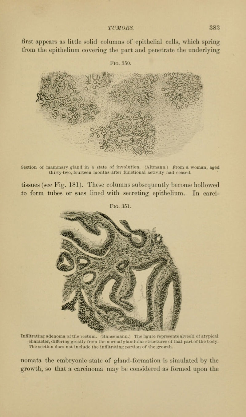 first appears as little solid columns of opitlielial cells, which spring from the epithelium eoverinsj; tht; part anil penetrate the underlying Fig. 350. Section of mammary gland in a state of involution, (.\ltmann.) From a woman, aged thirty-two, fourteen months after functional activity had ceased. tissues (see Fig. 181). These columns subsequently become hollowed to form tubes or sacs lined with secreting epithelium. In carci- Infiltratlng adenoma of the rectum, ninnseinann.i The tiirnre represents alveoli of atypical character, ditfering srreatly from the normal iilanduliir structures of that part of the body. The section does not include the infiltrating portion of the growth. nomata the embryonic state of gland-formation is simulated by the growth, so that a carcinoma may be considered as formed upon the