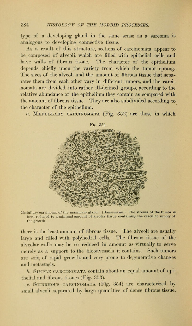 type of a developing gland in the same sense as a sarcoma is analogous to developing connective tissue. As a result of this structure, sections of carcinomata appear to be composed of alveoli, which are filled with epithelial cells and have walls of fibrous tissue. The character of the epithelium depends chiefly upon the variety from which the tumor sprang. The sizes of the alveoli and the amount of fibrous tissue that sepa- rates them from each other vary in different tumors, and the carci- nomata are divided into rather ill-defined groups, according to the relative abundance of the epithelium they contain as compared with the amount of fibrous tissue They are also subdivided according to the character of the epithelium. a. Medullary carcinomata (Fig. 352) are those in which Fig. 352, Medullary carcinoma of the mammary gland. (Hansemann.) The stroma of the tumor is here reduced to a minimal amount of areolar tissue containing the vascular supply of the growth. there is the least amount of fibrous tissue. The alveoli are usually large and filled with polyhedral cells. The fibrous tissue of the alveolar walls may be so reduced in amount as virtually to serve merely as a support to the bloodvessels it contains. Such tumors are soft, of rapid growth, and very prone to degenerative changes and metastasis. b. Simple carcinomata contain about an equal amount of epi- thelial and fibrous tissues (Fig. 353). c. Scirrhous carcinomata (Fig. 354) are characterized by small alveoli separated by large quantities of dense fibrous tissue.