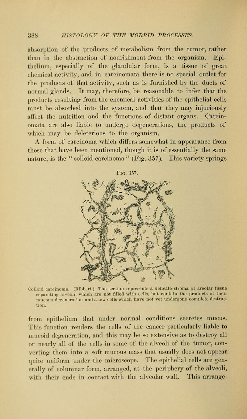 absorption of the products of metabolism from the tumor, rather than in the abstraction of nourishment from the organism. Epi- thelium, especially of the glandular form, is a tissue of great chemical activity, and in carcinomata there is no special outlet for the products of that activity, such as is furnished by the ducts of normal glands. It may, therefore, be reasonable to infer that the products resulting from the chemical activities of the epithelial cells must be absorbed into the system, and that they may injuriously affect the nutrition and the functions of distant organs. Carcin- omata are also liable to undergo degenerations, the products of which may be deleterious to the organism. A form of carcinoma which differs somewhat in appearance from those that have been mentioned, though it is of essentially the same nature, is the  colloid carcinoma  (Fig. 357). This variety springs Fig. 357. Colloid carcinoma. (Ribbert.) The section represents a delicate stroma of areolar tissue separating alveoli, which are not filled with cells, but contain the products of their mucous degeneration and a few cells which have not yet undergone complete destruc- tion. from epithelium that under normal conditions secretes mucus. This function renders the cells of the cancer particularly liable to mucoid degeneration, and this may })c so extensive as to destroy all or nearly all of the cells in some of the alveoli of the tumor, con- verting them into a soft mucous mass that usually does not appear quite uniform under tlie microscope. The epithelial cells are gen- erally of columnar form, arranged, at the periphery of the alVeoli, with their ends in contact with the alveolar wall. This arrange-