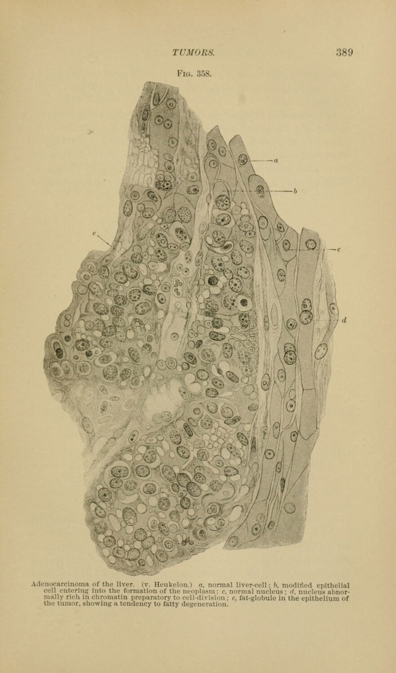 Via. 358. '^^ .m^m>!k I V '^y$ '.ajjA \: -.-^ ^, 'J •' r Adenocarcinoma of the liver, (w Ilcukelon.) a, normal liver-cell: h, modified epithelial cell enteriiii? into the formation of the ncojiliism: c, normal nucleus; </. nucleus abnor- mally rich in chromatin preparatory to cell-division ; e, fat-globule in the epithelium of the tumor, showing a tendency to fatty degeneration.