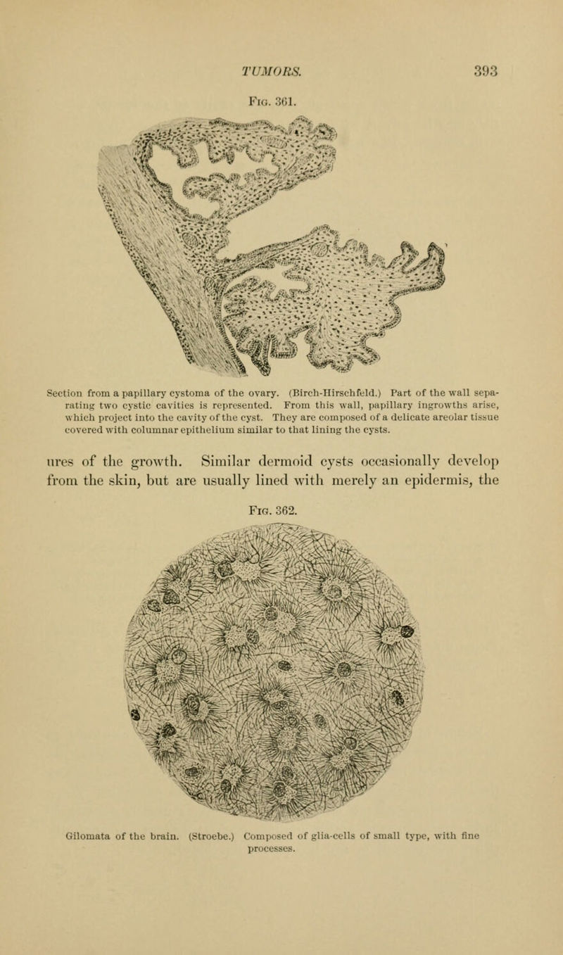 Fig. 301. €-^ Section from a papillary cystoma of the ovary. (Birch-IIirsclifcld.) Part of the wall sepa- rating two cystic cavities is represented. From this wall, papillary ingrowths arise, which project into the cavity of tlie cyst. They are comymsed of a delicate areolar tissue covered with columnar epithelium similar to that lining the cysts. ures of the growth. Similar dermoid cysts occasionally develop from the skin, but are usually lined with merely an epidermis, the Fig. 362. fe^?^fel^#S^ Gilomata of the brain. (Stroebe.) Composed of glia-cells of small type, with fine processes.