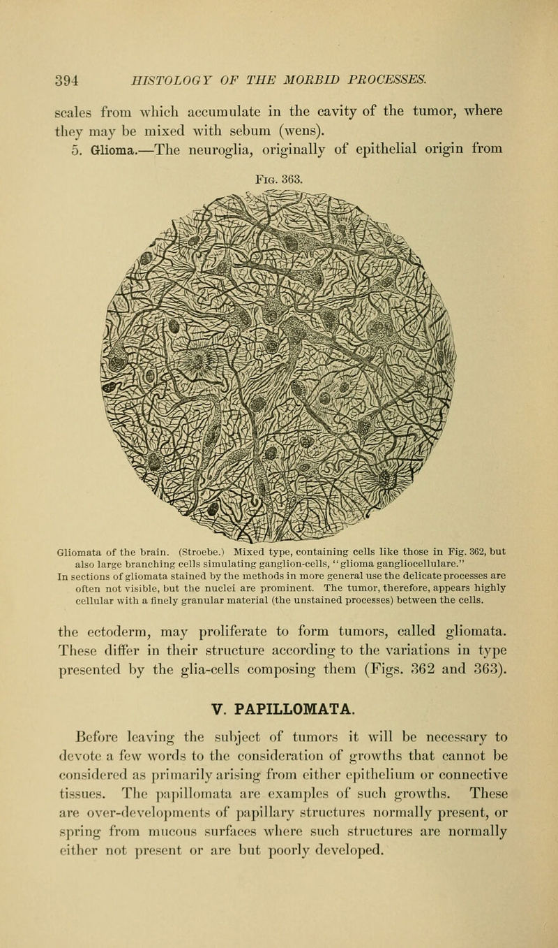 scales from which accumulate in the cavity of the tumor, where they may be mixed with sebum (wens). 5. Grlioma.—The neuroglia, originally of epithelial origin from Fig. 363. Gliomata of the brain. (Stroebe.) Mixed type, containing cells like those in Fig. 362, but also large branching cells simulating ganglion-cells, glioma gangliocellulare. In sections of gliomata stained by the methods in more general use the delicate processes are often not visible, but the nuclei are prominent. The tumor, therefore, appears highly cellular with a finely granular material (the unstained processes) between the cells. the ectoderm, may proliferate to form tumors, called gliomata. These diifer in their structure according to the variations in type presented by the glia-cells composing them (Figs. 362 and 363). V. PAPILLOMATA. Before leaving the subject of tumors it will be necessary to devote a few words to the consideration of growths that cannot be considered as primarily arising from either epithelium or connective tissues. The papillomata arc exam])les of such growths. These are over-developments of papillary structures normally present, or spring from mucous surfaces where such structures are normally either not present or are but poorly developed.