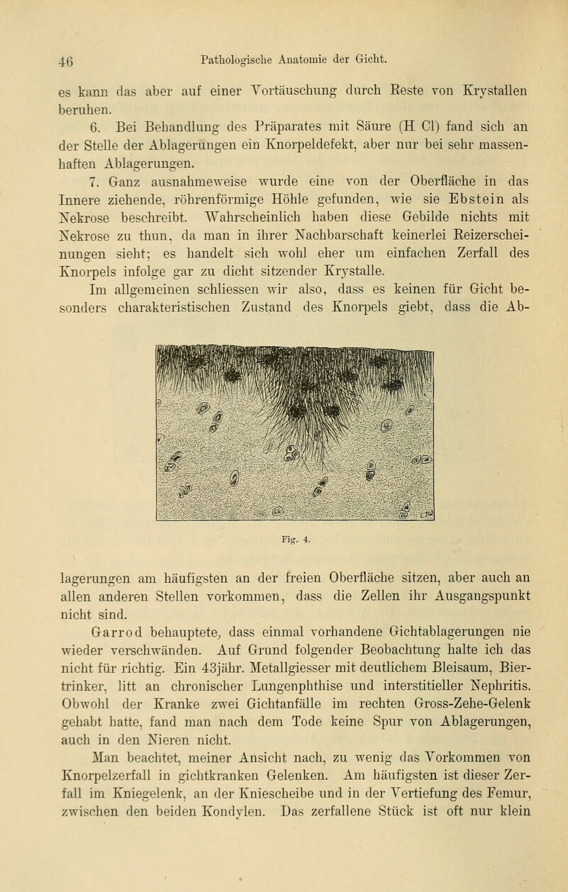 es kann das aber auf einer Yortäuschung durch Beste von Krystallen beruhen. 6. Bei Behandlung des Präparates mit Säure (H Cl) fand sich an der Stelle der Ablagerungen ein Knorpeldefekt, aber nur bei sehr massen- haften Ablagerungen. 7. Ganz ausnahmeweise wurde eine von der Oberfläche in das Innere ziehende, röhrenförmige Höhle gefunden, wie sie Ebstein als Nekrose beschreibt. Wahrscheinlich haben diese Gebilde nichts mit Nekrose zu thun, da man in ihrer Nachbarschaft keinerlei Reizerschei- nungen sieht; es handelt sich wohl eher um einfachen Zerfall des Knorpels infolge gar zu dicht sitzender Krystalle. Im allgemeinen schliessen wir also, dass es keinen für Gicht be- sonders charakteristischen Zustand des Knorpels giebt, dass die Ab- ü 1 ''|](/)!\\'fi|™ ■ Wm P 9 5 4 1 '^i 1 ^ \ \i 1 -' ? ' 'j- ' ^ rijli> .- _ ~ ^ '^ Fig. 4. lagerungen am häufigsten an der freien Oberfläche sitzen, aber auch an allen anderen Stellen vorkommen, dass die Zellen ihr Ausgangspunkt nicht sind. Garrod behauptete, dass einmal vorhandene Gichtablagerungen nie wieder verschwänden. Auf Grund folgender Beobachtung halte ich das nicht für richtig. Ein 43jähr. Metallgiesser mit deutlichem Bleisaum, Bier- trinker, litt an chronischer Lungenphthise und interstitieller Nephritis. Obwohl der Kranke zwei Gichtanfälle im rechten Gross-Zehe-Gelenk gehabt hatte, fand man nach dem Tode keine Spur von Ablagerungen, auch in den Nieren nicht. Man beachtet, meiner Ansicht nach, zu wenig das Vorkommen von Knorpelzerfall in gichtkranken Gelenken. Am häufigsten ist dieser Zer- fall im Kniegelenk, an der Kniescheibe und in der Vertiefung des Femur, zwischen den beiden Kondylen. Das zerfallene Stück ist oft nur klein