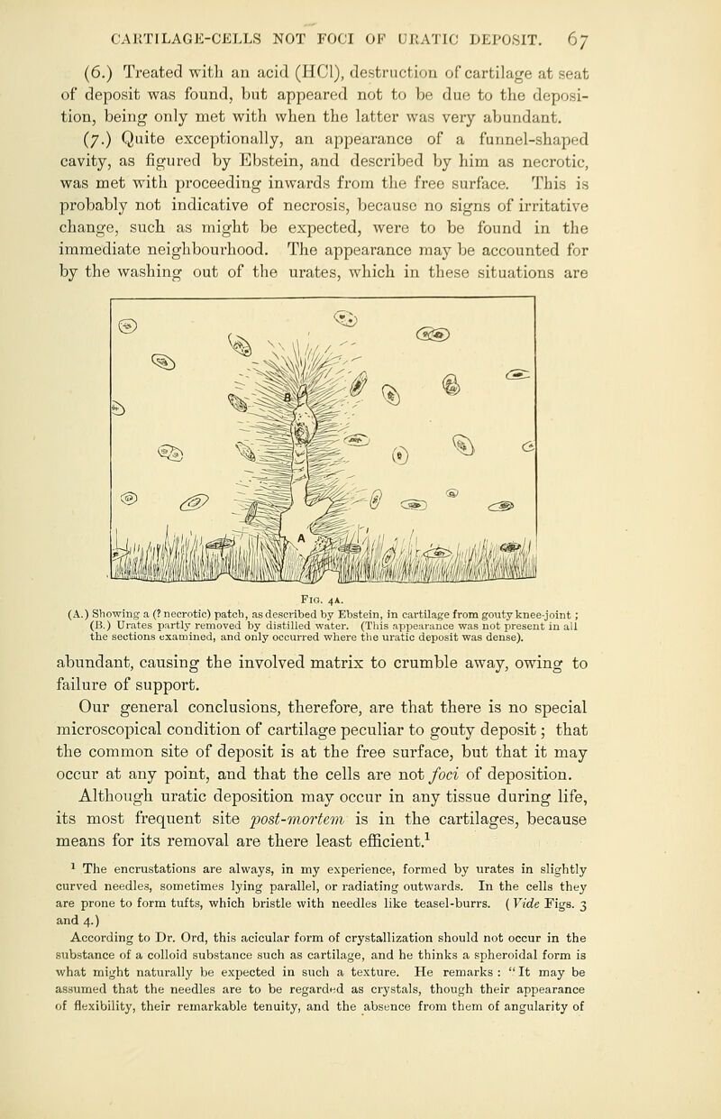 (6.) Treated with an acid (HC1), destruction of cartilage at seat of deposit was found, but appeared not to be due to the deposi- tion, being only met with when the latter was very abundant. (7.) Quite exceptionally, an appearance of a funnel-shaped cavity, as figured by Ebstein, and described by him as necrotic, was met with proceeding inwards from the free surface. This is probably not indicative of necrosis, because no signs of irritative change, such as might be expected, were to be found in the immediate neighbourhood. The appearance may be accounted for by the washing out of the urates, which in these situations are Fig. 4A. (A.) Showing a (? necrotic) patch, as described by Ebstein, in cartilage from gouty knee-joint; (B.) Urates partly removed by distilled water. (This appearance was not present in all the sections examined, and only occurred where the uratic deposit was dense). abundant, causing the involved matrix to crumble away, owing to failure of support. Our general conclusions, therefore, are that there is no special microscopical condition of cartilage peculiar to gouty deposit; that the common site of deposit is at the free surface, but that it may occur at any point, and that the cells are not foci of deposition. Although uratic deposition may occur in any tissue during life, its most frequent site post-mortem is in the cartilages, because means for its removal are there least efficient.1 1 The encrustations are always, in my experience, formed by urates in slightly curved needles, sometimes lying parallel, or radiating outwards. In the cells they are prone to form tufts, which bristle with needles like teasel-burrs. (Vide Figs. 3 and 4.) According to Dr. Ord, this acicular form of crystallization should not occur in the substance of a colloid substance such as cartilage, and he thinks a spheroidal form is what might naturally be expected in such a texture. He remarks :  It may be assumed that the needles are to be regarded as crystals, though their appearance of flexibility, their remarkable tenuity, and the absence from them of angularity of