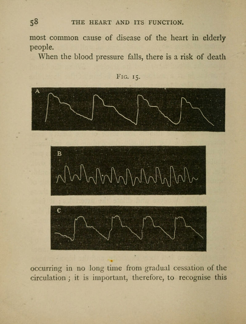 most common cause of disease of the heart in elderly people. When the blood pressure falls, there is a risk of death Fig. 15. occurring in no long time from gradual cessation of the circulation ; it is important, therefore, to recognise this