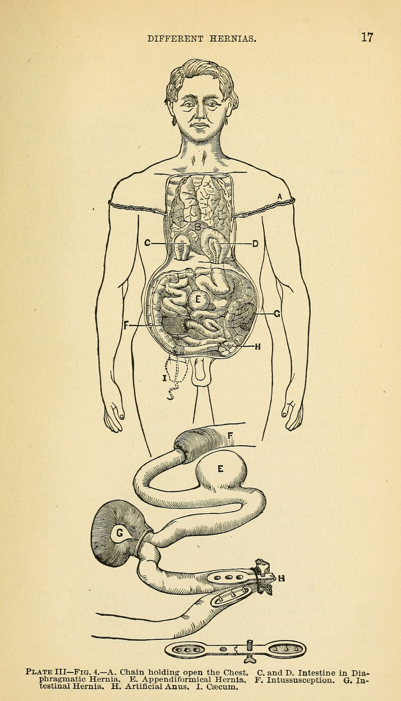 PliATE III—Fig. 4.—a. Chain holding open the Chest, C. and D. Intestine in Dia- phragmatic Hernia. E. Appendiformical Hernia. F. Intussusception. G. In- testinal Hernia. H. Artificial Anus. I. Caecum.