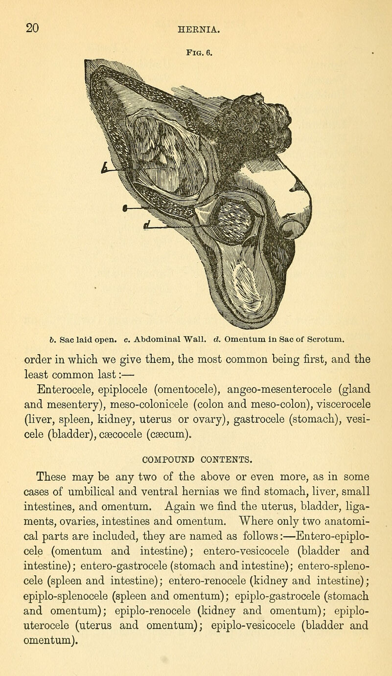 b. Sac laid open. c. Abdominal Wall. d. Omentum in Sac of Scrotum. order in whicli we give them, the most common being first, and the least common last:— Enterocele, epiplocele (omentocele), angeo-mesenterocele (gland and mesentery), meso-colonicele (colon and meso-colon), viscerocele (liver, spleen, kidney, uterus or ovary), gastrocele (stomach), vesi- cele (bladder), csecocele (csecum). COMPOUND CONTENTS. These may be any two of the above or even more, as in some cases of umbilical and ventral hernias we find stomach, liver, small intestines, and omentum. Again we find the uterus, bladder, liga- ments, ovaries, intestines and omentum. Where only two anatomi- cal parts are included, they are named as follows:—Entero-epiplo- cele (omentum and intestine); entero-vesicocele (bladder and intestine); entero-gastrocele (stomach and intestine); entero-spleno- cele (spleen and intestine); entero-renocele (kidney and intestine); epiplo-splenocele (spleen and omentum); epiplo-gastrocele (stomach and omentum); epiplo-renocele (kidney and omentum); epiplo- uterocele (uterus and omentum); epiplo-vesicocele (bladder and omentum).