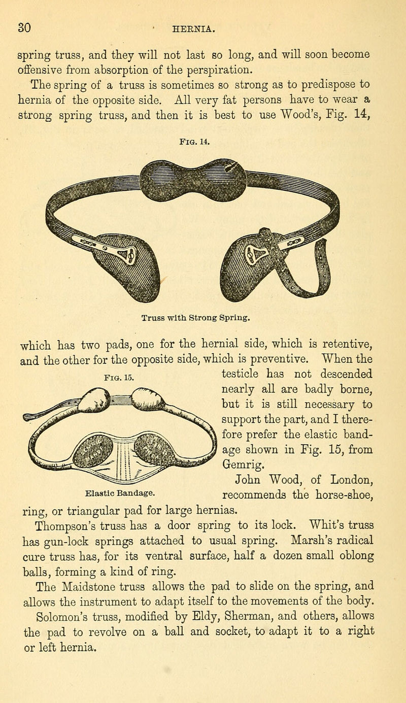 spring truss, and they will not last so long, and will soon become offensive from absorption of the perspiration. The spring of a truss is sometimes so strong as to predispose to hernia of the opposite side. All very fat persons have to wear a strong spring truss, and then it is best to use Wood's, Fig. 14, Fig. 14. Fig. 15. Truss with Strong Spring. which has two pads, one for the hernial side, which is retentive, and the other for the opposite side, which is preventive. When the testicle has not descended nearly all are badly borne, but it is still necessary to support the part, and I there- fore prefer the elastic band- age shown in Fig. 15, from Gemrig. John Wood, of London, recommends the horse-shoe, ring, or triangular pad for large hernias. Thompson's truss has a door spring to its lock. Whit's truss has gun-lock springs attached to usual spring. Marsh's radical cure truss has, for its ventral surface, half a dozen small oblong balls, forming a kind of ring. The Maidstone truss allows the pad to shde on the spring, and aUows the instrument to adapt itself to the movements of the body. Solomon's truss, modified by Eldy, Sherman, and others, allows the pad to revolve on a ball and socket, to adapt it to a right or left hernia. Elastic Bandage.