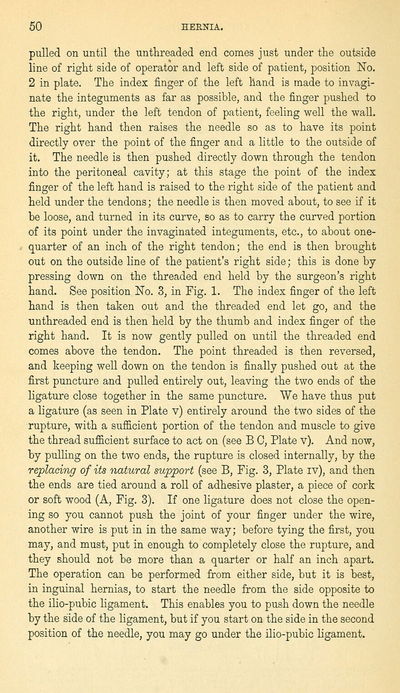 pulled on until the unthreaded end comes just under the outside line of right side of operator and left side of patient, position No. 2 in plate. The index finger of the left hand is made to invagi- nate the integuments as far as possible, and the finger pushed to the right, under the left tendon of patient, feeling well the wall. The right hand then raises the needle so as to have its point directly over the point of the finger and a little to the outside of it. The needle is then pushed directly down through the tendon into the peritoneal cavity; at this stage the point of the index finger of the left hand is raised to the right side of the patient and held under the tendons; the needle is then moved about, to see if it be loose, and turned in its curve, so as to carry the curved portion of its point under the invaginated integuments, etc., to about one- quarter of an inch of the right tendon; the end is then brought out on the outside line of the patient's right side; this is done by pressing down on the threaded end held by the surgeon's right hand. See position ISFo. 3, in Fig. 1. The index finger of the left hand is then taken out and the threaded end let go, and the unthreaded end is then held by the thumb and index finger of the right hand. It is now gently pulled on until the threaded end comes above the tendon. The point threaded is then reversed, and keeping well down on the tendon is finally pushed out at the first puncture and pulled entirely out, leaving the two ends of the ligature close together in the same puncture. We have thus put a ligature (as seen in Plate v) entirely around the two sides of the rupture, with a sufficient portion of the tendon and muscle to give the thread sufficient surface to act on (see B 0, Plate v). And now, by pulling on the two ends, the rupture is closed internally, by the replacing of its natural support (see B, Fig. 3, Plate iv), and then the ends are tied around a roll of adhesive plaster, a piece of cork or soft wood (A, Fig. 3). If one ligature does not close the open- ing so you cannot push the joint of your finger under the wire, another wire is put in in the same way; before tying the first, you may, and must, put in enough to completely close the rupture, and they should not be more than a quarter or half an inch apart. The operation can be performed from either side, but it is best, in inguinal hernias, to start the needle from the side opposite to the ilio-pubic ligament. This enables you to push down the needle by the side of the ligament, but if you start on the side in the second position of the needle, you may go under the ilio-pubic ligament.