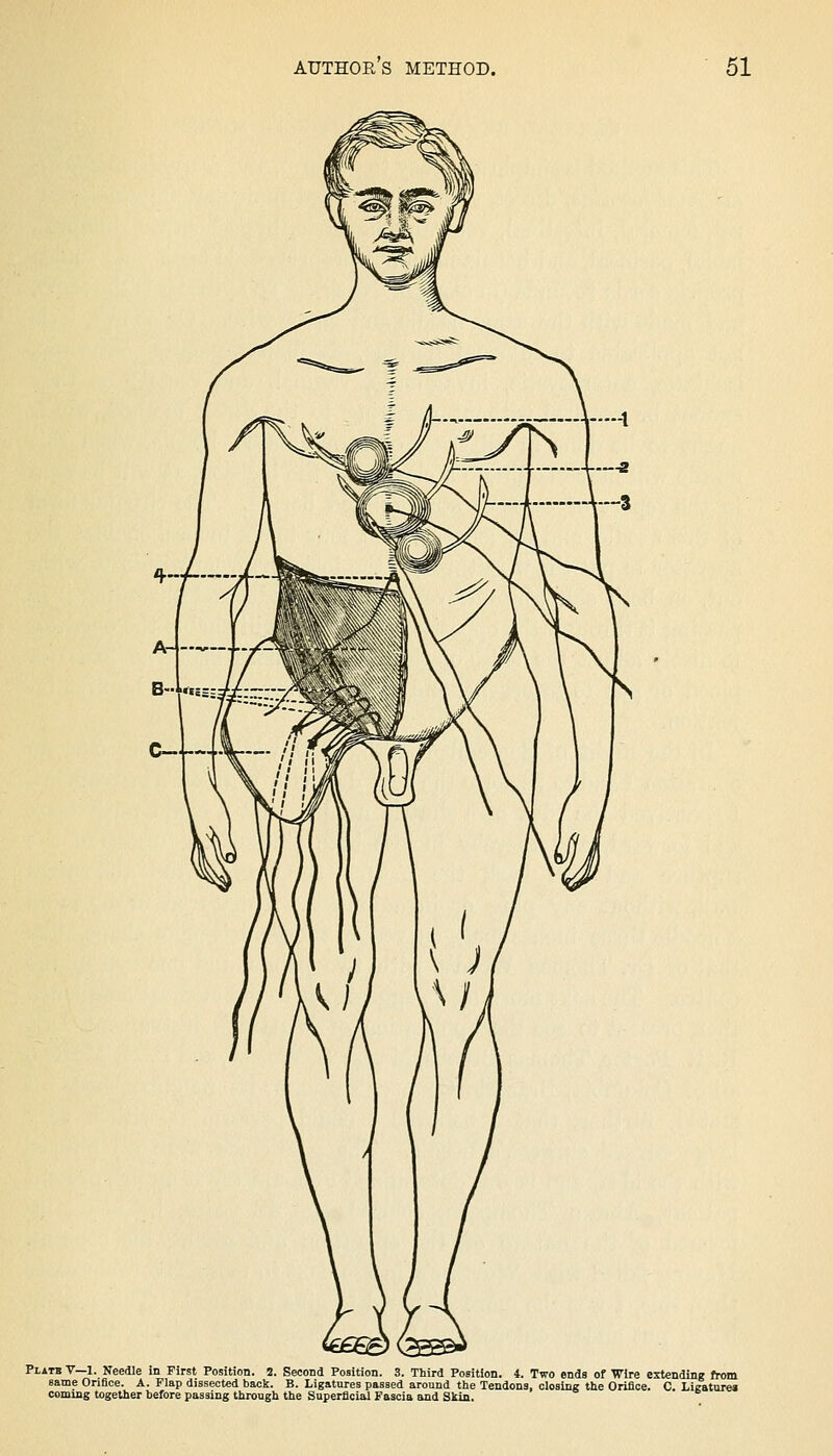 Platb V—1. Needle in First Position. 2. Second Position. 3. Third Position. 4. Two ends of Wire extending from same Orifice. A. Flap dissected back. B. Ligatures passed around the Tendons, closing the Orifice. C. Lieature* coming together before passing through the Superficial Fascia and Skin.