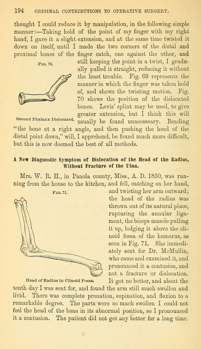 Fig. 70. thouglit I could reduce it by manipulation, in the following simple manner:—Taking hold of the point of my finger with my right hand, I gave it a slight extension, and at the same time twisted it down on itself, until I made the two corners of the distal and proximal bones of the finger catch, one against the other, and still keeping the point in a twist, I gradu- ally pulled it straight, reducing it without the least trouble. Fig. 69 represents the manner in which the finger was taken hold of, and shows the twisting motion. Fig. 70 shows the position of the dislocated bones. Levis' splint may be used, to give greater extension, but I think this will second Phalanx Dislocated. ^^^^^^ ^^ ^^^^^ Unnecessary. Bending the bone at a right angle, and then pushing the head of the distal point down, will, I apprehend, be found much more difficult, but this is now deemed the best of all methods. Fig. 71. A ITew Diagnostic Symptom of Dislocation of the Head of the Radius, Without Fracture of the Ulna. Mrs. W. E. H., in Panola county, Miss., A. D. 1850, was run- ning from the house to the kitchen, and fell, catching on her hand, and twisting her arm outward; the head of the radius was thrown out of its natural place, rupturing the annular liga- ment, the biceps muscle pulling it up, lodging it above the cli- noid fossa of the humerus, as seen in Fig. 71. She immedi- ately sent for Dr. McMullin, who came and examined it, and pronounced it a contusion, and not a fracture or dislocation. It got no better, and about the tenth day I was sent for, and found the arm still much swollen and livid. There was complete pronation, supination, and flexion to a remarkable degree. The parts were so much swollen I could not feel the head of the bone in its abnormal position, so I pronounced it a contusion. The patient did not get any better for a long time. Head of Radius in Clinoid Fossa,