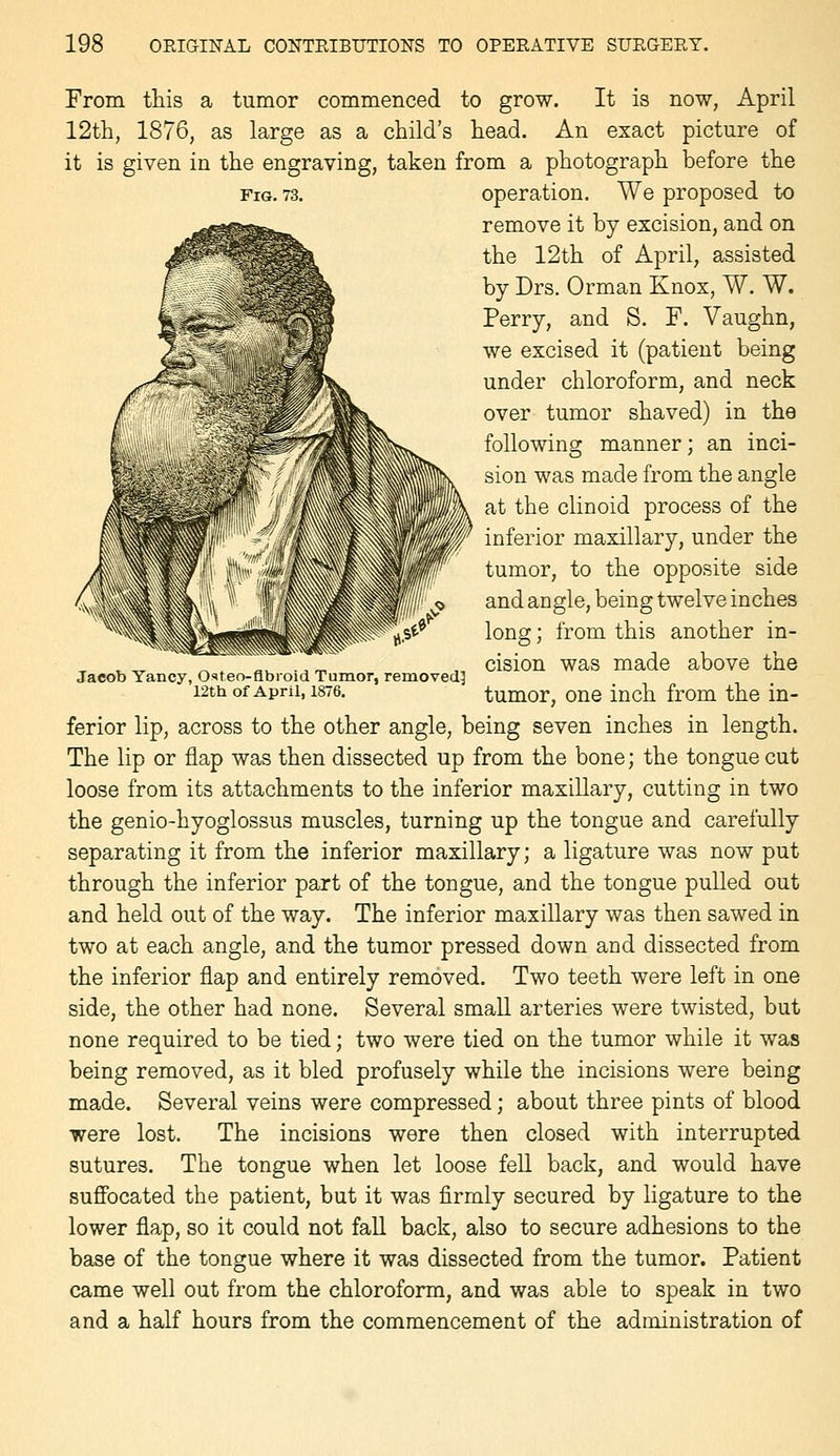 Jacob Yancy, Osteo-flbroid Tumor, removed^ 12thof April, 1876. From this a tumor commenced to grow. It is now, April 12th, 1876, as large as a child's head. An exact picture of it is given in the engraving, taken from a photograph before the Fig. 73. Operation. We proposed to remove it by excision, and on the 12th of April, assisted by Drs. Orman Knox, W. W. Perry, and S. F. Vaughn, we excised it (patient being under chloroform, and neck over tumor shaved) in the following manner; an inci- sion was made from the angle at the clinoid process of the inferior maxillary, under the tumor, to the opposite side and angle, being twelve inches long; from this another in- cision was made above the tumor, one inch from the in- ferior lip, across to the other angle, being seven inches in length. The lip or flap was then dissected up from the bone; the tongue cut loose from its attachments to the inferior maxillary, cutting in two the genio-hyoglossus muscles, turning up the tongue and carefully separating it from the inferior maxillary; a ligature was now put through the inferior part of the tongue, and the tongue pulled out and held out of the way. The inferior maxillary was then sawed in two at each angle, and the tumor pressed down and dissected from the inferior flap and entirely removed. Two teeth were left in one side, the other had none. Several small arteries were twisted, but none required to be tied; two were tied on the tumor while it was being removed, as it bled profusely while the incisions were being made. Several veins were compressed; about three pints of blood were lost. The incisions were then closed with interrupted sutures. The tongue when let loose fell back, and would have suffocated the patient, but it was firmly secured by ligature to the lower flap, so it could not fall back, also to secure adhesions to the base of the tongue where it was dissected from the tumor. Patient came well out from the chloroform, and was able to speak in two and a half hours from the commencement of the administration of