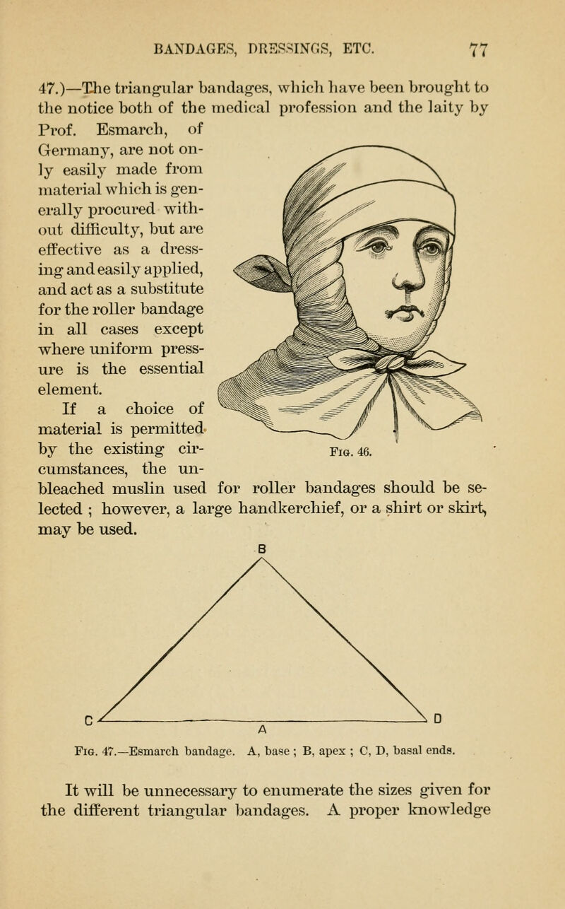 47.)—The triangular baiidages, whicli have been brought to the notice both of the medical profession and the laity by Prof. Esmarch, of Germany, are not on- ly easily made from material which is gen- erally procured with- out difficulty, but are effective as a dress- ing and easily applied, and act as a substitute for the roller bandage in all cases except where uniform press- ure is the essential element. If a choice of material is permitted by the existing cir- cumstances, the un- bleached muslin used for roller bandages should be se- lected ; however, a large handkerchief, or a shirt or skirt, may be used. Fig. 46. Fig. 47.—Esmarch bandage. A, base ; B, apex ; C, D, basal ends. It will be unnecessary to enumerate the sizes given for the different triangular bandages. A proper knowledge