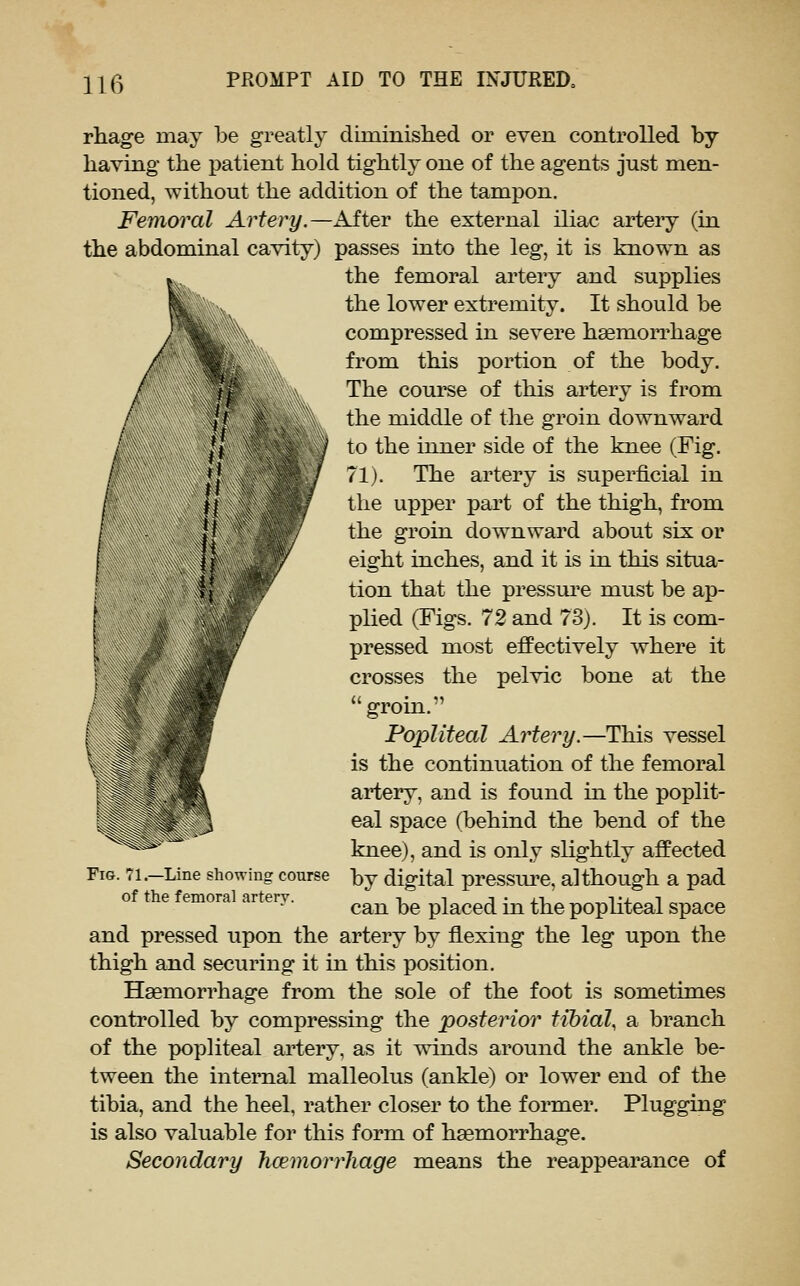 rhage may be greatly climinislied or even controlled by having the patient hold tightly one of the agents just men- tioned, without the addition of the tampon. Femoral Artery.—After the external iliac artery (in the abdominal cavity) passes into the leg, it is known as the femoral artery and supplies the lower extremity. It should be compressed in severe hsemorrhage from this portion of the body. The course of this artery is from the middle of the groin downward to the inner side of the knee (Fig. 71). The artery is superficial in the upper part of the thigh, from the groin downward about six or eight inches, and it is in this situa- tion that the pressui'e must be ap- plied (Figs. 72 and 73). It is com- pressed most effectively where it crosses the pelvic bone at the groin. Popliteal Artery.—This vessel is the continuation of the femoral artery, and is found in the poplit- eal space (behind the bend of the knee), and is only slightly affected by digital pressure, although a pad can be placed in the popliteal space and pressed upon the artery by flexing the leg upon the thigh and securing it in this position. Haemorrhage from the sole of the foot is sometimes controlled by compressing the posterior tibial, sl branch of the popliteal artery, as it winds around the ankle be- tween the internal malleolus (ankle) or lower end of the tibia, and the heel, rather closer to the former. Plugging is also valuable for this form of haemorrhage. Secondary haemorrhage means the reappearance of Fig. 71.—Line showing course of the femoral arterv.