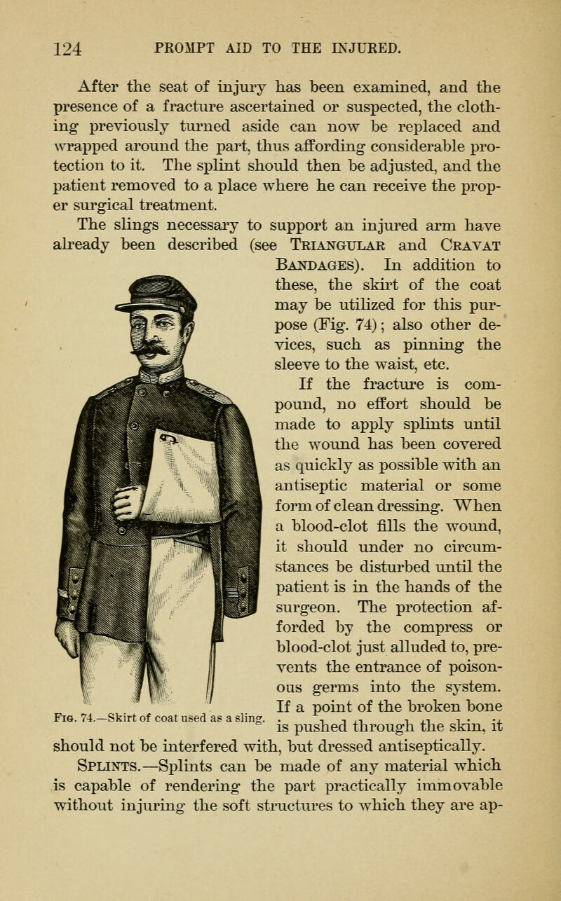 After the seat of injury has been examined, and the presence of a fracture ascertained or suspected, the cloth- ing j)reviously turned aside can now be replaced and \^'rapped around the i)art, thus affording considerable pro- tection to it. The splint should then be adjusted, and the patient removed to a place where he can receive the prop- er surgical treatment. The slings necessary to support an injured arm have already been described (see Triangular and Cravat Bandages). In addition to these, the skii't of the coat may be utilized for this pur- pose (Fig. 74); also other de- vices, such as pinning the sleeve to the waist, etc. If the fracture is com- pound, no effort should be made to apply splints until the wound has been covered as quickly as possible with an antiseptic material or some form of clean dressing. When a blood-clot fills the wound, it should under no circum- stances be disturbed until the patient is in the hands of the surgeon. The protection af- forded by the compress or blood-clot just alluded to, pre- vents the entrance of poison- ous germs into the system. If a point of the broken bone is pushed through the skin, it should not be interfered with, but dressed antiseptically. Splints.—Splints can be made of any material which is capable of rendering the part practically immovable without injuring the soft structures to which they are ap- Fia. 74.—Skirt of coat used as a slino;.