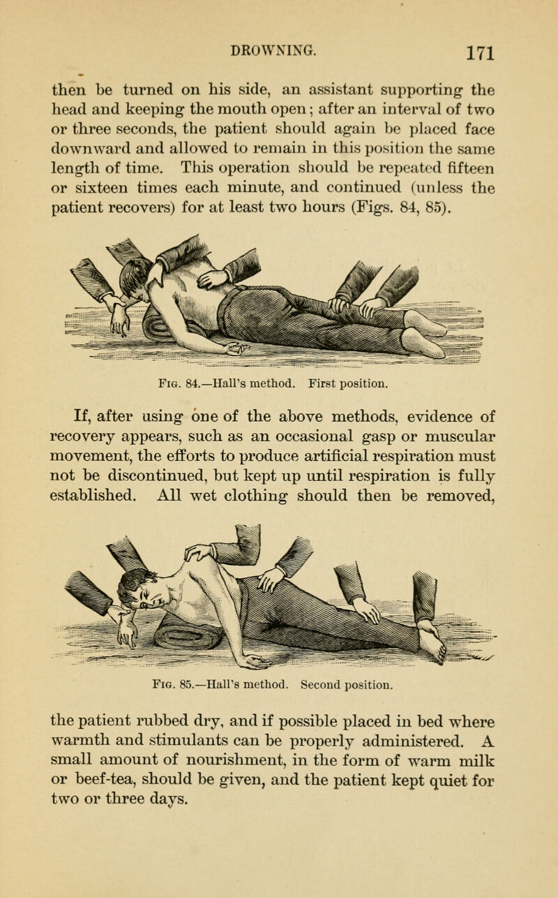 then be turned on his side, an assistant supporting the head and keeping the mouth open; after an interval of two or three seconds, the patient should again be placed face downward and allowed to remain in this position the same length of time. This operation should be repeated fifteen or sixteen times each minute, and continued (unless the patient recovers) for at least two hours (Figs. 84, 85). Fig. 84.—Hall's method. First position. If, after using one of the above methods, evidence of recovery appears, such as an occasional gasp or muscular movement, the efforts to produce artificial respiration must not be discontinued, but kept up until respiration is fully established. All wet clothing should then be removed, Fig. 85.—Hall's method. Second position. the patient rubbed dry, and if possible placed in bed where warmth and stimulants can be properly administered. A small amount of nourishment, in the form of warm milk or beef-tea, should be given, and the patient kept quiet for two or three days.