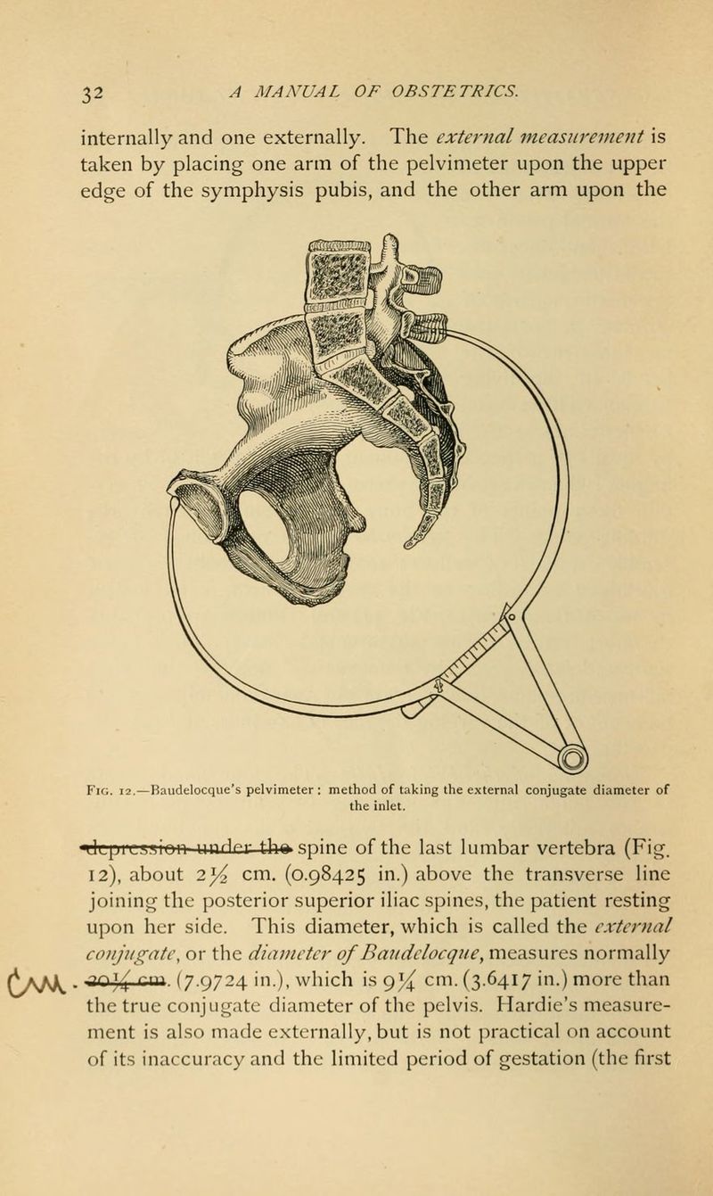 internally and one externally. The external measurement is taken by placing one arm of the pelvimeter upon the upper edge of the symphysis pubis, and the other arm upon the Fig. 12.—Baudelocque's pelvimeter ; method of taking the external conjugate diameter of the inlet. nJLpriiA.'.ion unHf:r tho spine of the last lumbar vertebra (Fig. 12), about 2^ cm. (0.98425 in.) above the transverse line joining the posterior superior iliac spines, the patient resting upon her side. This diameter, which is called the external co)iju(!^ate, or the diameter of Dandelocque, measures normally . ^o)^ Qx\\. (7.9724 in.), which is 95^ cm. (3.6417 in.) more than the true conjugate diameter of the pelvis. Hardie's measure- ment is also made externally, but is not practical on account of its inaccuracy and the limited period of gestation (the first