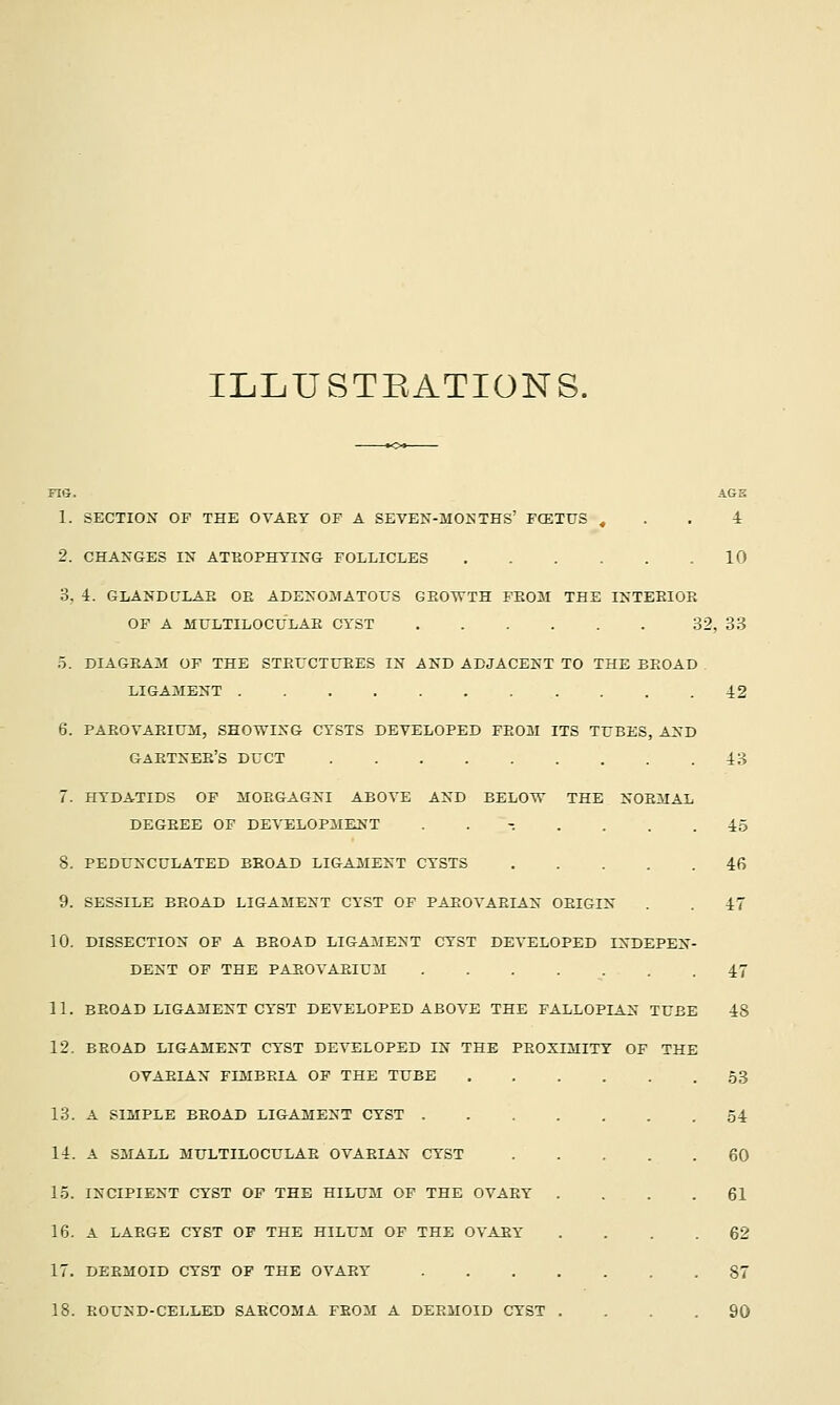 ILLUSTEATIONS. Fie. 1. 2. 3, SECTIOX OF THE OVAEY OF A SEVEN-MOlsTHS' FCETUS , CHANGES IX ATKOPHTING FOLLICLES .... AGS 4 10 4. GLANDULAE OE ADEXOirATOUS GEOTVTH FEOM THE INTEEIOE OF A MTJLTILOCULAE CYST 32, 33 DIAGEAM OF THE STErCTUEES IN AND ADJACENT TO THE EEOAD LIGAMENT PAEOVAEIUM, SHOWING CYSTS DEVELOPED FE03I ITS TrBES, AND GAETNEE'S DUCT HYDATIDS OF ilOEGAGNI ABOVE AND BELOTV THE NOEMAL DEGEEE OF DEVEL0P3IENT ........ 8. 9. 10. 11. 12. 13. 14. 15. 16. 17. 18. PEDUNCULATED BEOAD LIGAMENT CYSTS SESSILE BEOAD LIGAMENT CYST OF PAEOVAEIAN OEIGIN DISSECTION OF A BEOAD LIGAMENT CYST DEVELOPED INDEPEN- DENT OF THE PAEOVAEIUM A SIMPLE EEOAD LIGAMENT CYST . A SMALL MULTILOCULAE OVARIAN CYST INCIPIENT CYST OF THE HILUM OF THE OVAEY A LAEGE CYST OF THE HILUM OF THE OVAEY DERMOID CYST OP THE OVARY EOUSD-CELIiED SARCOMA FROM A DERMOID CYST 42 43 45 46 47 47 BEOAD LIGAMENT CYST DEVELOPED ABOVE THE FALLOPIAN TUBE 48 BEOAD LIGAMENT CYST DEVELOPED IN THE PROXIMITY OF THE OVAEIAN FIMBRIA OP THE TUBE 53 54 60 61 62 87 90