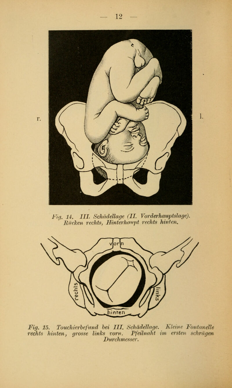 Fig. 14. IIL Schädellage (IL Vorderhawptslage). Riicken rechts, Hinterho'upt rechts hinten. Fig. 15. Touchierhefund hei III. Schädellage. Kleive Fontanelle rechts hinten, grosse linlcs vorn. Pfeilnaht im ersten schrägen