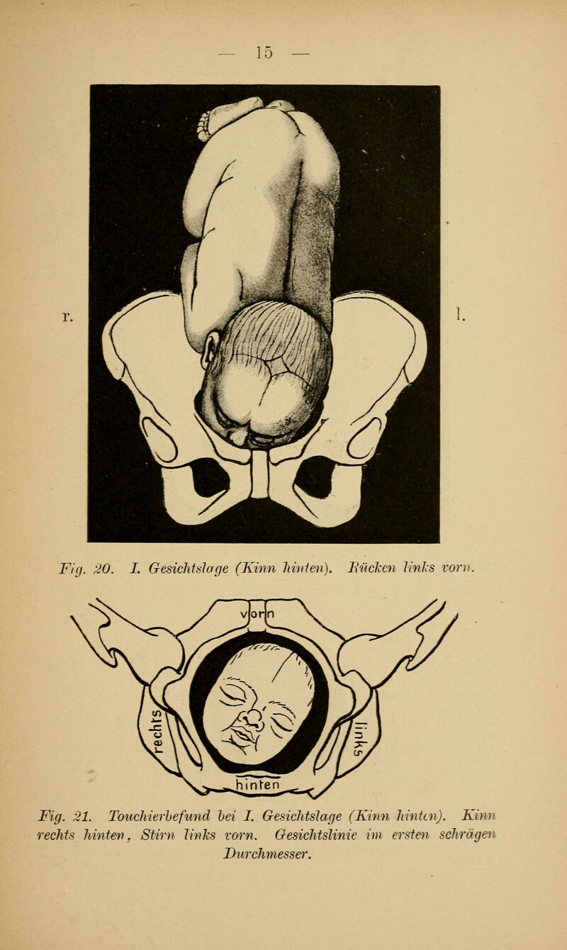 Fig. 20. I. Gesichtslage (Kinn hinlen). Bücken links vorn. Fig. 21. Touchierhefioid hei I. Gesichtslage (Kinn hinten). Kirm rechts hinten, Stirn links vorn. Gesichtslinie im ersten schrägen