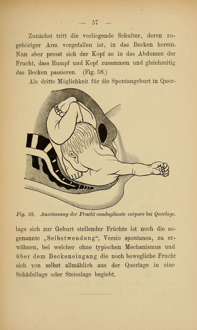 Ol Zunächst tritt die vorliegende Schulter, deren zu- gehöriger Arm vorgefallen ist, in das Becken herein. Nun aber presst sich der Kopf so in das Abdomen der Frucht, dass Kumpf und Kopf zusammen und gleichzeitig das Becken passieren. (Fig. 58.) Als dritte Möglichkeit für die Spontangeburt in Quer- Fig. 58, Ausstossung der Frucht condupUcato corpore hei Querlage. läge sich zur Geburt stellender Früchte ist noch die so- genannte „SelbstWendung, Yersio spontanea, zu er- wähnen, bei welcher ohne typischen Mechanismus und über dem Beckeneingang die noch bewegliche Frucht sich von selbst allmählich aus der Qaerlage in eine Schädellage oder Steisslage begiebt.