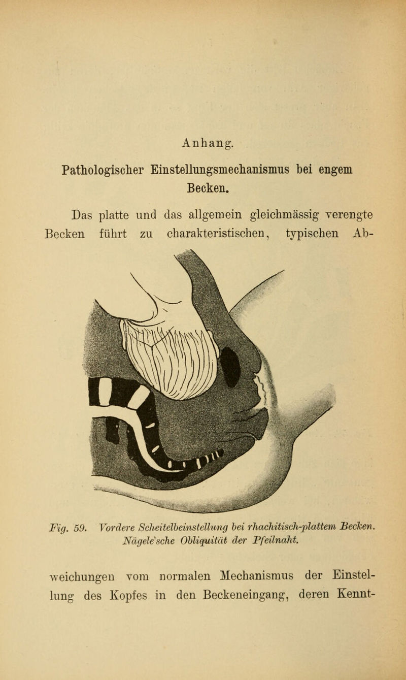 Anhang. Pathologisclier Einstelluiigsiiiecliaiiisiiius bei engem Becken. Das platte und das allgemein gleichmässig verengte Becken führt zu charakteristischen, typischen Ab- Fig. 59. Vordere Scheitelheinstellung bei rhachitisch-plattem Becken. Nügele'sche Obliquität der Pfeilnaht. Aveichungen vom normalen Mechanismus der Einstel- lung des Kopfes in den Beckeneingang, deren Kennt-