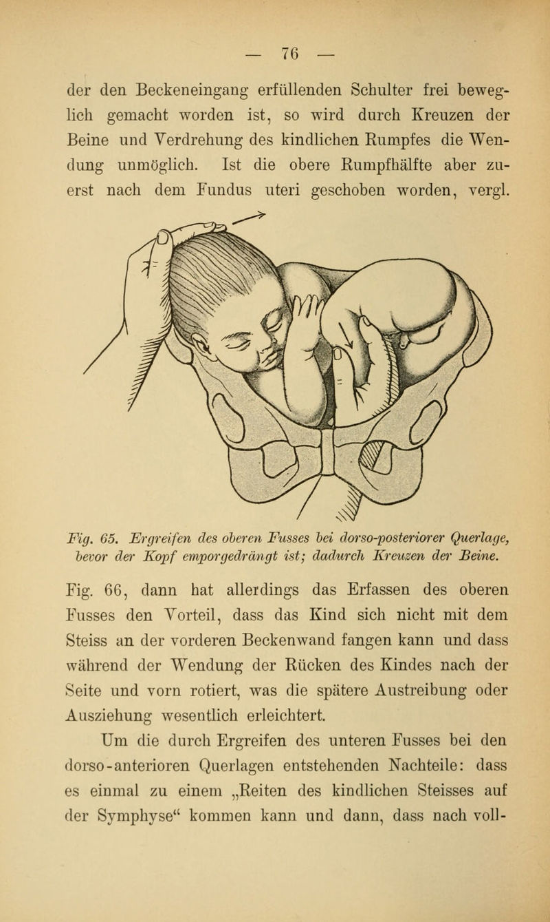 der den Beckeneingang erfüllenden Schulter frei beweg- lich gemacht worden ist, so wird durch Kreuzen der Beine und Verdrehung des kindlichen Rumpfes die Wen- dung unmöglich. Ist die obere Rumpfhälfte aber zu- erst nach dem Fundus uteri geschoben worden, vergl. Fig. 65. Ergreifen des oberen Fusses bei dorso-posteriorer Querlage, bevor der Kopf emporgedrängt ist; dadurch Kreuzen der Beine. Fig. 66, dann hat allerdings das Erfassen des oberen Fusses den Yorteil, dass das Kind sich nicht mit dem Steiss an der vorderen Beckenwand fangen kann und dass während der Wendung der Rücken des Kindes nach der Seite und vorn rotiert, was die spätere Austreibung oder Ausziehung wesentlich erleichtert. Um die durch Ergreifen des unteren Fusses bei den dorso-anterioren Querlagen entstehenden Nachteile: dass es einmal zu einem „Reiten des kindlichen Steisses auf der Symphyse kommen kann und dann, dass nach voll-