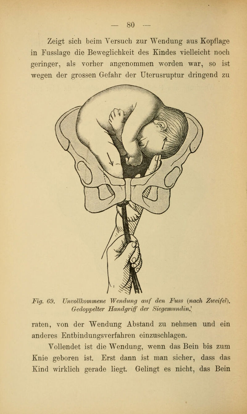 Zeigt sich beim Yersuch zur Wendung aus Kopflage in Fusslage die Beweglichkeit des Kindes vielleicht noch geringer, als vorher angenommen worden war, so ist wegen der grossen Gefahr der Uterusruptur dringend zu Fig. 69. Unvollkommene Wendtmg auf den Fuss (nach Zweifel), Gedoppelter Handgriff der Siegemundin,\ raten, von der Wendung Abstand zu nehmen und ein anderes Entbindungsverfahren einzuschlagen. Yollendet ist die Wendung, wenn das Bein bis zum Knie geboren ist. Erst dann ist man sicher, dass das Kind wirklich gerade liegt. Gelingt es nicht, das Bein