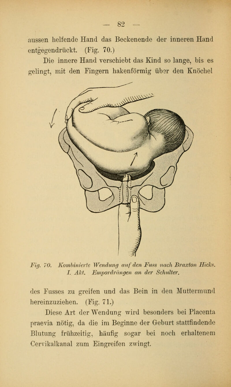 aussen helfende Hand das Beckenende der inneren Hand entgegendrüctt. (Fig. 70.) Die innere Hand verschiebt das Kind so lange, bis es gelingt, mit den Fingern hakenförmig über den Knöchel Fig. 70. Kombinierte Wendung auf den Fuss nach Braxton Hicks. I. AJd, Empordrängen an der Scliidter. des Fasses zu greifen und das Bein in den Muttermund hereinzuziehen. (Fig. 71.) Diese Art der Wendung wird besonders bei Placenta praevia nötig, da die im Beginne der Geburt stattfindende Blutung frühzeitig, häufig sogar bei noch erhaltenem Cervikalkanal zum Eingreifen zwingt.