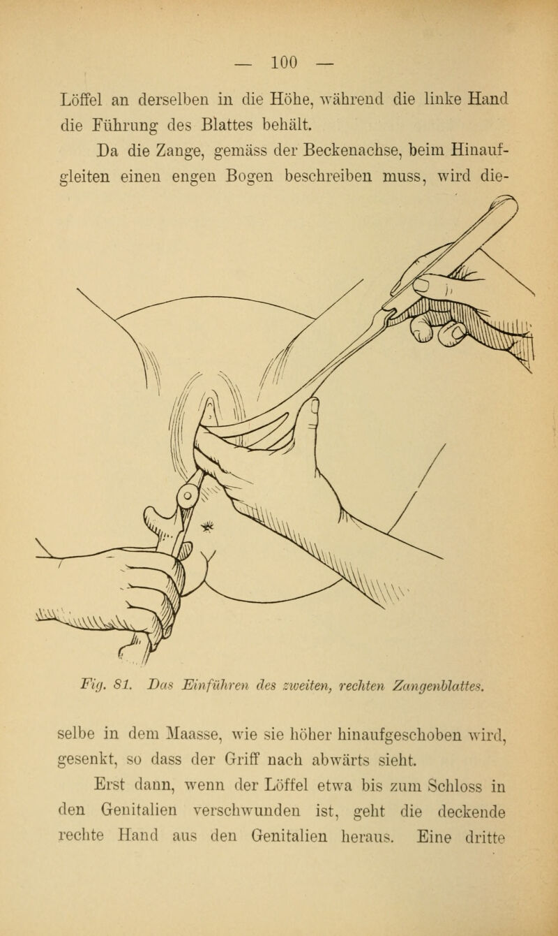 Löffel an derselben in die Höhe, während die linke Hand die Führung des Blattes behält. Da die Zange, gemäss der Beekenachse, beim Hinauf- gleiten einen engen Bogen beschreiben muss, wird die- ^^\\V^ >\v^'s\. Fig. Sl, Das Einführen des nveiten, rechten Zangenhlattes. selbe in dem Maasse, wie sie höher hinaufgeschoben wird, gesenkt, so dass der Griff nach abwärts sieht. Erst dann, wenn der Löffel etwa bis zum Schloss in den Genitalien verschwunden ist, geht die deckende rechte Hand aus den Genitalien heraus. Eine dritte