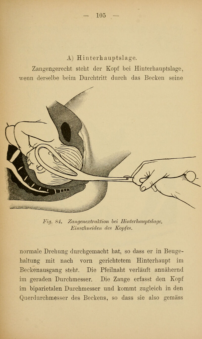A) Hinterhauptslage. Zangengerecbt steht der Kopf bei Hinterhauptslage, wenn derselbe beim Darchtritt durch das Becken seine Fig. S4. Zangenextraktion hei Hinterhauj)tslage. JEinschneideii des Kopfes. normale Drehung durchgemacht hat, so dass er in Beuge- haltung mit nach vorn gerichtetem Hinterhaupt im Beckenauss:ano; steht. Die Pfeilnaht verläuft annähernd im geraden Durchmesser. Die Zange erfasst den Kopf im biparietalen Durchmesser und kommt zugleich in den Qnerdurchmesser des Beckens, so dass sie also gemäss