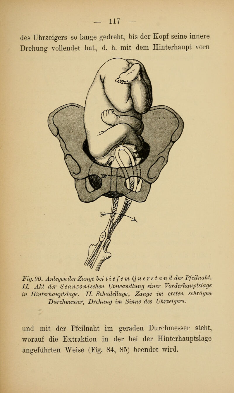 des Uhrzeigers so lange gedreht, bis der Kopf seine innere Drehung vollendet hat, d. h. mit dem Hinterhaupt vorn Fig. 90. Anlegender Zange bei tiefem Quer stand der Pfeilnaht. II. Akt der Scanzonischen Umwandlung einer Vorderhatvptslage in Hinterhauptslage. II. Schädellage, Zange im ersten schrägen Durchmesser, Drehung im Sinne des Uhrzeigers. und mit der Pfeilnaht im geraden Durchmesser steht, worauf die Extraktion in der bei der Hinterhauptslage angeführten Weise (Fig. 84, 85) beendet wird.