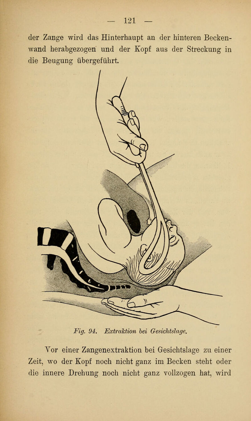 der Zange wird das Hinterhaupt an der hinteren Becken- wand herabgezogen und der Kopf aus der Streckung in die Beugung übergeführt. Fig. 94. Extraktion bei Gesichtslage, Yor einer Zangenextraktion bei Gesichtslage zu einer Zeit, wo der Kopf noch nicht ganz im Becken steht oder die innere Drehung noch nicht ganz vollzogen hat, wird