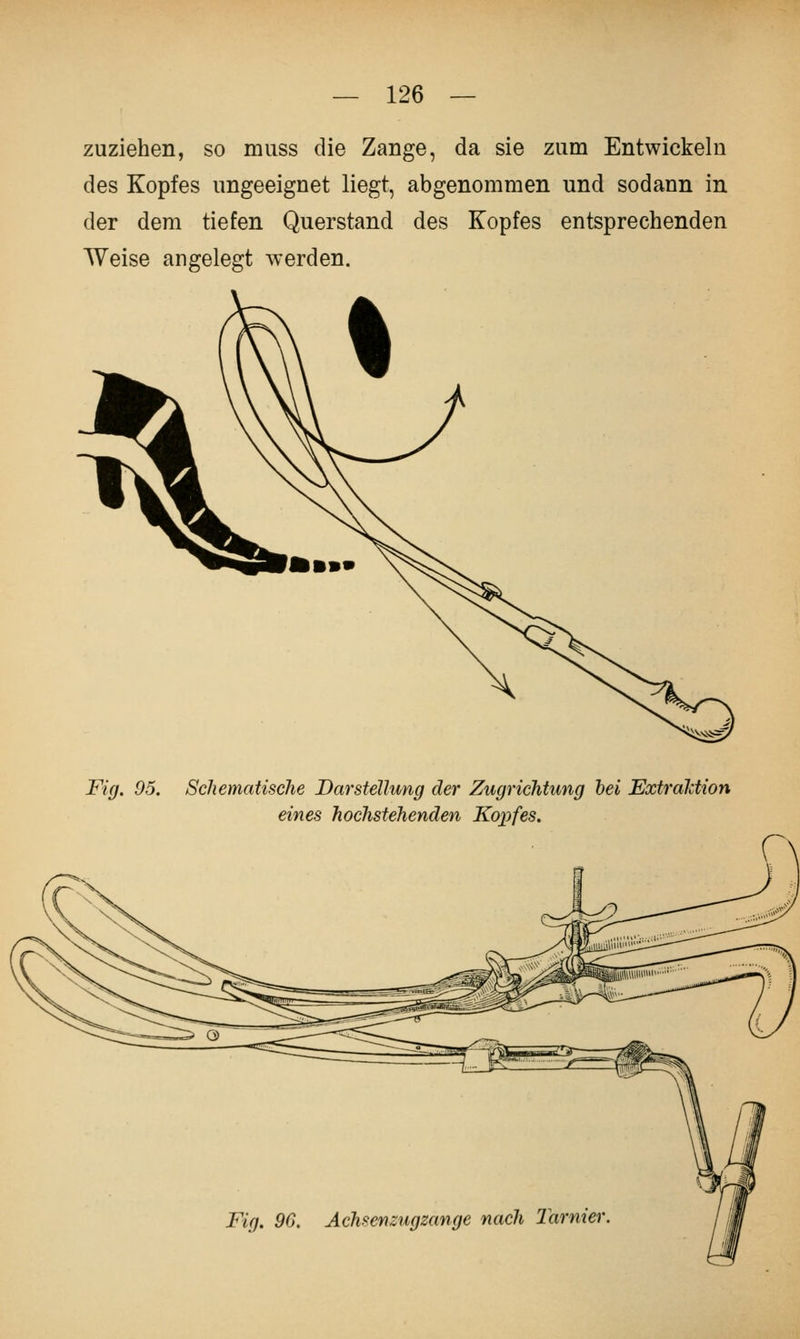 zuziehen, so muss die Zange, da sie zum Entwickeln des Kopfes ungeeignet liegt, abgenommen und sodann in der dem tiefen Querstand des Kopfes entsprechenden Weise angelegt werden. Fig. 05. SchematiscJie Darstellung der Zugrichtung hei Extraldion eines hochstehenden Kopfes. Fig. 96. Achsenzugzange nach larnier.