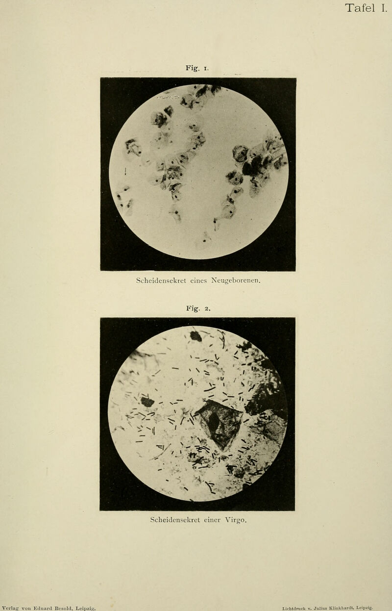 Fig. I. Scheidensekret eines Neugeborenen. Fig. 2. Scheidensekret einer Virgo.