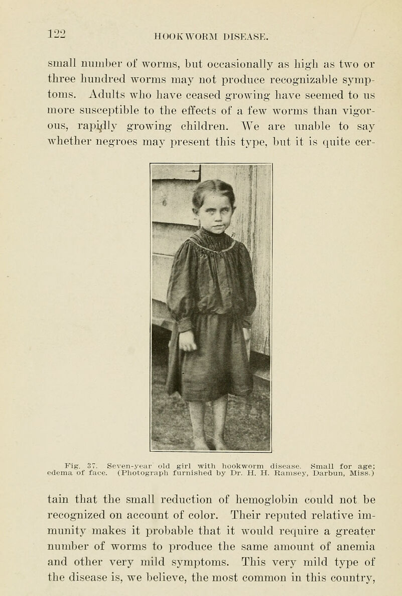 small number of worms, but occasionally as liigii as two or three hundred worms may not produce recognizable symp- toms. Adults who have ceased growing have seemed to us more susceptible to the effects of a few worms than vigor- ous, rapidly growing children. We are unable to say whether negroes maj joresent this type, but it is quite cer- Fig. 37. Seven-year old girl with hookworm disease. Small for age; edema of face. (Photograph furnished by Dr. H. H. Ramsey, Darbun, Miss.) tain that the small reduction of hemoglobin could not be recognized on account of color. Their reputed relative im- munity makes it probable that it would require a greater number of worms to produce the same amount of anemia and other very mild symptoms. This very mild type of the disease is, we believe, the most common in this country.