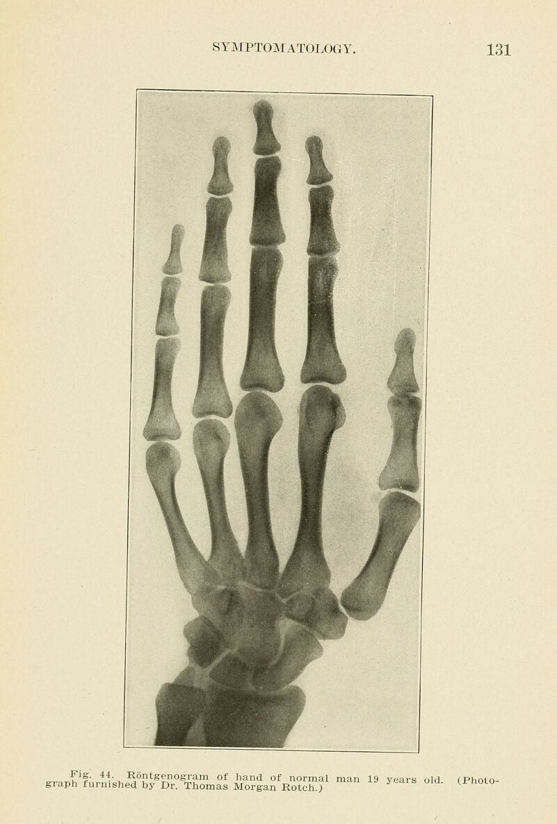 ....or^'^^§■ 44. Rontgenogram of hand of normal man 19 years old graph furnished by Dr. Thomas Morgan Rotch.) (Photo-