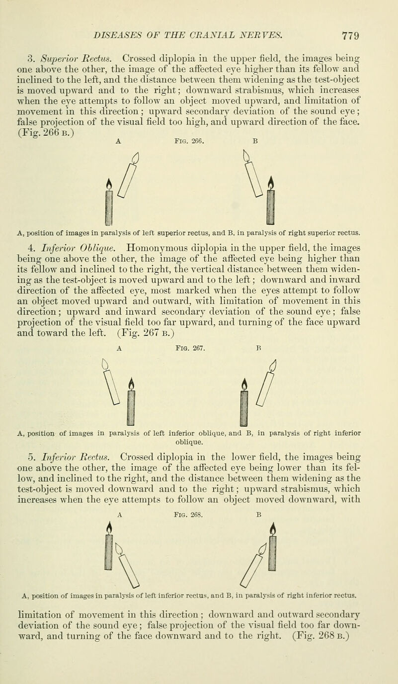 3. Superior Rectus. Crossed diplopia in the upper field, the images being one above the other, the image of the affected eye higher than its fellow and inclined to the left, and the distance between them widening as the test-object is moved upward and to the right; downward strabismus, which increases when the eye attempts to follow an object moved upward, and limitation of movement in this direction ; upward secondary deviation of the sound eye; false projection of the visual field too high, and upward direction of the face. (Fig. 266 B.) A Fig. 266. A, position of images in paralysis of left superior rectus, and B, in paralysis of right superior rectus. 4. Inferior Oblique. Homonymous diplopia in the upper field, the images being one above the other, the image of the afifected eye being higher than its fellow and inclined to the right, the vertical distance between them widen- ing as the test-object is moved upward and to the left; downward and inward dii'ection of the affected eye, most marked when the eyes attempt to follow an object moved upward and outward, with limitation of movement in this direction; upward and inward secondary deviation of the sound eye; false projection of the visual field too far upward, and turning of the face upward and toward the left. (Fig. 267 b.) A Fig. 267. A, position of images in paralysis of left inferior oblique, and B, in paralysis of right inferior oblique. 5. Inferior Rectus. Crossed diplopia in the lower field, the images being one above the other, the image of the affected eye being lower than its fel- low, and inclined to the right, and the distance between them widening as the test-object is moved downward and to the right; upward strabismus, which increases when the eye attempts to follow an object moved downward, with A Fig. 268. A, position of images in paralysis of left inferior rectus, and B, in paralysis of right inferior rectus. limitation of movement in this direction ; downward and outward secondary deviation of the sound eye; false projection of the visual field too far down- ward, and turning of the face downward and to the right. (Fig. 268 B.)