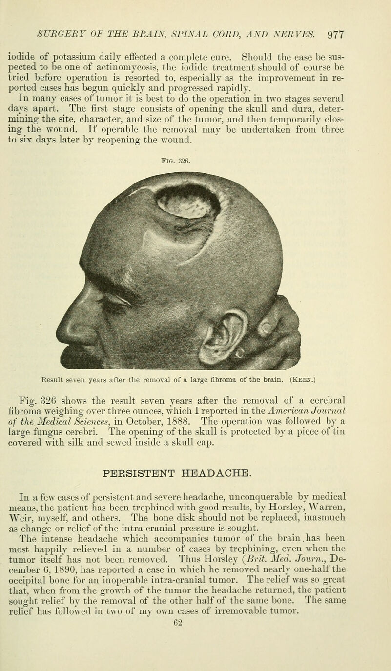 iodide of potassium daily effected a complete cure. Should the case be sus- pected to be one of actinomycosis, the iodide treatment should of course be tried before operation is resorted to, especially as the improyement in re- ported cases has begun quickly and progressed rapidly. In many cases of tumor it is best to do the operation in two stages seyeral days ajoart. The first stage consists of opening the skull and dura, deter- mining the site, character, and size of the tumor, and then temporarily clos- ing the wound. If operable the remoyal may be undertaken from three to six days later by reopening the wound. Fig. 326. Result seven years after the removal of a large fibroma of the brain. (Keen.) Fig. 326 shows the result seyen years after the removal of a cerebral fibroma weighing oyer three ounces, which I reported in the American Journal of the. Medical Sciences, in October, 1888. The operation was followed by a large fungus cerebri. The opening of the skull is protected by a piece of tin covered with silk and sewed inside a skull cap. PERSISTENT HEADACHE. In a few cases of persistent and severe headache, unconquerable by medical means, the patient has Ijeen trephined with good results, l)y Horsley, Warren, Weir, myself, and others. The bone disk should not be replaced, inasmuch as change or relief of the intra-cranial pressure is sought. The intense headache which accompanies tumor of the brain. has been most happily relieved in a number of cases by trephining, even when the tumor itself has not been removed. Thus Horsley \Brit. Med. Journ., De- cember 6, 1890, has reported a case in which he removed nearly one-half the occipital bone for an inoperable intra-cranial tumor. The relief was so great that, when from the growth of tlie tumor the headache returned, the patient sought relief by the removal of the other half of the same bone. The same relief has followed in two of my own cases of irremovable tumor. 62