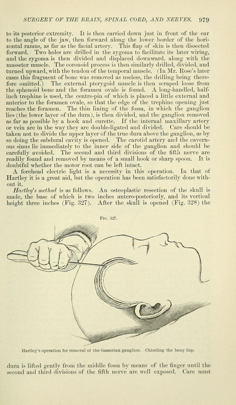 to its posterior extremity. It is then carried down just in front of the ear to the angle of the jaw, then forward along the lower border of the hori- zontal ramus, as far as the facial artery. This flap of skin is then dissected forward. Two holes are drilled in the zygoma to facilitate its later wiring, and the zygoma is then divided and displaced downward, along with the masseter muscle. The coronoid process is then similarly drilled, divided, and turned upward, with the tendon of the temporal muscle. (In Mr. Rose's later cases this fragment of bone was removed as useless, the drilling being there- fore omitted.) The external pterygoid muscle is then scraped loose from the sphenoid bone and the foramen ovale is found. A long-handled, half- inch trephine is used, the centre-pin of which is placed a little external and anterior to the foramen ovale, so that the edge of the trephine opening just reaches the foramen. The thin lining of the fossa, in which the ganglion lies (the lower layer of the dura), is then divided, and the ganglion removed as far as possible by a hook and curette. If the internal maxillary artery or vein are in the way they are double-ligated and divided. Care should be taken not to divide the upper layer of the true dura above the ganglion, as by so doing the subdural cavity is opened. The carotid artery and the cavern- ous sinus lie immediately to the inner side of the ganglion and should be carefuUy avoided. The second and third divisions of the fifth nerve are readily found and removed by means of a small hook or sharp spoon. It is doubtful whether the motor root can be left intact. A forehead electric light is a necessity in this operation. In that of Hartley it is a great aid, but the operation has been satisfactorily done with- out it. Hartley's method is as follows. An osteoplastic resection of the skull is made, the base of which is two inches antero-posteriorly, and its vertical height three inches (Fig. 327). After the skull is opened (Fig. 328) the Fig. 327. Hartley's operation for removal ol the Gasserian ganglion. Chiseling the bony flap. -dui'a is lifted gently from the middle fossa by means of the finger until the second and third divisions of the fifth nerve are well exposed. Care must