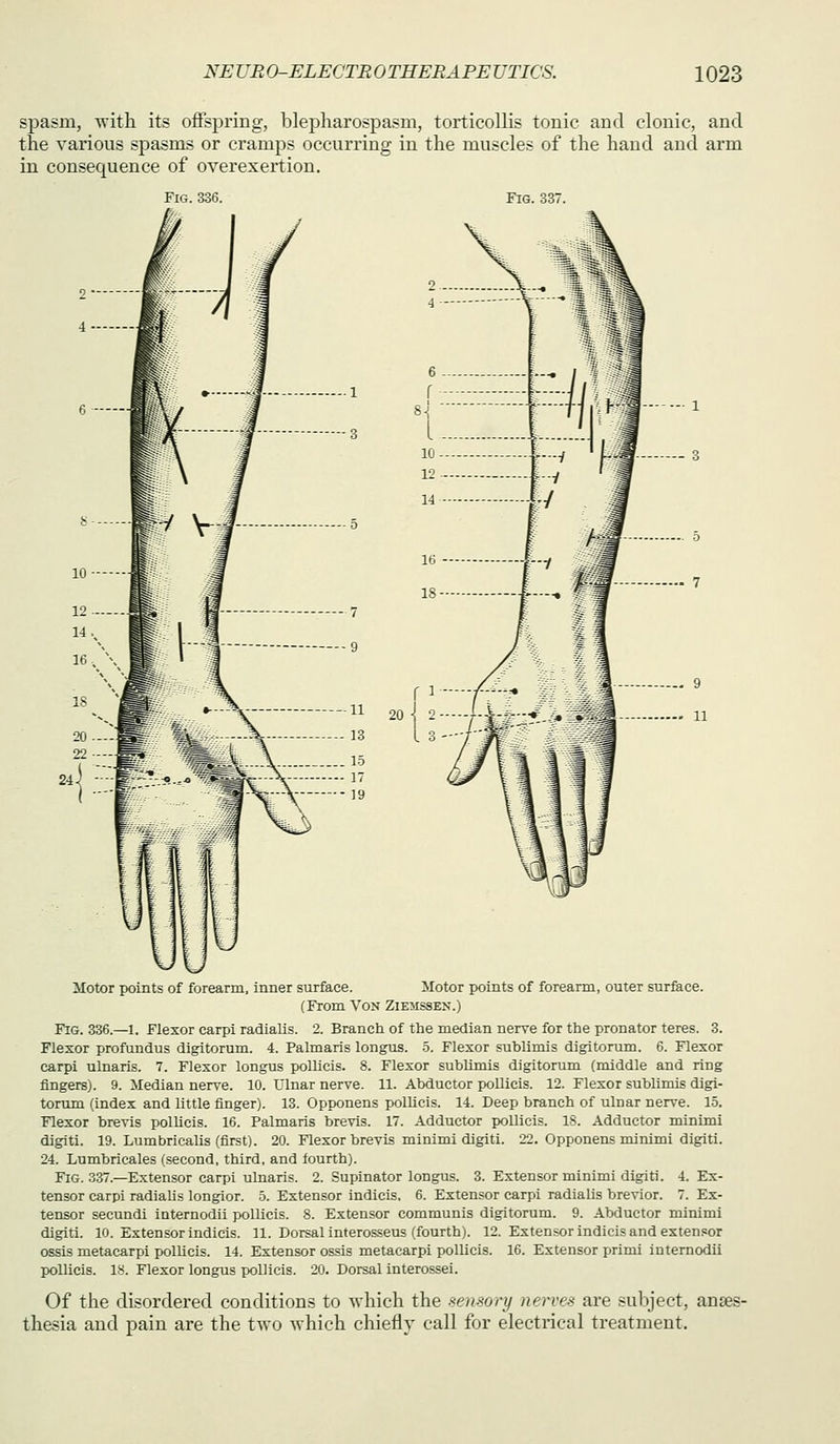 spasm, -with its ofispring, blepharospasm, torticollis tonic and clonic, and the various spasms or cramps occurring in the muscles of the hand and arm in consequence of overexertion. Fig 336 Fig. 337. 8^ I 10 12 14 =1/ / 20 -^ 2- Motor points of forearm, inner surface. Motor points of forearm, outer surface. (From Von Ziemssen.) Fig. 336.—1. Flexor carpi radialis. 2. Branch of the median nerve for the pronator teres. 3. Flexor profundus digitorum. 4. Palmaris longus. 5. Flexor sublimis digitorum. 6. Flexor carpi ulnaris. 7. Flexor longus pollicis. 8. Flexor sublimis digitorum (middle and ring fingers). 9. Median nerve. 10. Ulnar nerve. 11. Abductor pollicis. 12. Flexor sublimis digi- torum (index and little finger). 13. Opponens pollicis. 14. Deep branch of ulnar nerve. 15. Flexor brevis pollicis. 16. Palmaris brevis. 17. Adductor pollicis. 18. Adductor minimi digiti. 19. Lumbricalls (first). 20. Flexor brevis minimi digiti. 22. Opponens minimi digiti. 24. Lumbricales (second, third, and fourth). Fig. 337.—Extensor carpi ulnaris. 2. Supinator longus. 3. Extensor minimi digiti. 4. Ex- tensor carpi radialis longior. 5. Extensor indicis. 6. Extensor carpi radialis brevior. 7. Ex- tensor secundi internodii pollicis. 8. Extensor communis digitorum. 9. Abductor minimi digiti. 10. Extensor indicis. 11. Dorsal interosseus (fourth). 12. Extensor indicis and extensor ossis metacarpi polUcis. 14. Extensor ossis metacarpi pollicis. 16. Extensor primi internodii pollicis. 18. Flexor longus pollicis. 20. Dorsal interossei. Of the disordered conditions to which the -sensory nerves are subject, anses- thesia and pain are the two which chiefly call for electrical treatment.