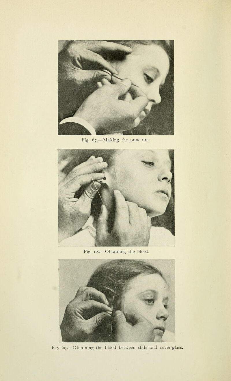 Fig. 67.—Making the puncture. Fig. 69.—Obtaining the blood between slide and cover-glass.
