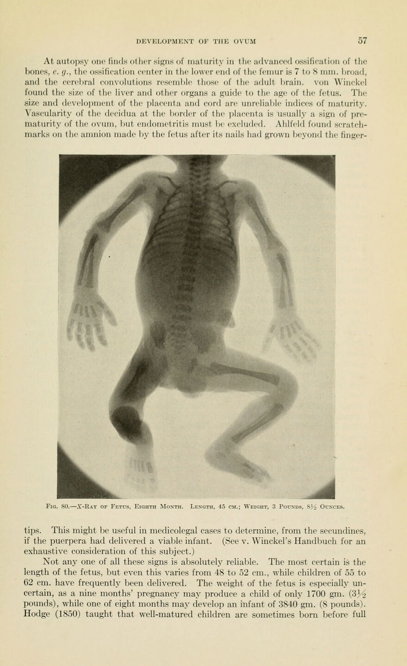 At autopsy one [iuds ot licf si};iis of matiii'ily in llic advanced ossification of the bonos, c. (/., tlic ossification ccnttT in the lower end oi the femur is 7 to 8 iniii. l)r(jad, and the e(>rel)ral convohitions resemble those of the adult brain, von Winckel found the size of the liver and other organs a guide 1o the age of the fetus. Tfie size and (le\'elo))nient of the placenta and cord are unrelial)le indices of maturit}'. Vascularity of the decidua at the border of the placenta is usually a sign of jjre- maturity of \\w ovum, but endometritis must b(- excluded. Ahlfeld found scratch- marks on the anuiion made by the fetus after its nails had grown beyond the hnger- FiG. so.—.Y-Ray of Fetus, Eighth Month. Length, 45 cm.; Weight, 3 Pounds, S'o Ounces. tips. This might be useful in medicolegal cases to determine, from the secundines, if the puerpera had delivered a viable infant. (See v. Winckel's Handbuch for an exhaustive consideration of this subject.) Not any one of all these signs is absolutely reliable. The most certain is the length of the fetus, but even this varies from 48 to 52 cm., while children of 55 to 62 cm. have frequently been delivered. The weight of the fetus is especially un- certain, as a nine months' pregnancy may produce a child of only 1700 gm. (33^ pounds), while one of eight months may develop an infant of 3840 gm. (8 pounds). Hodge (1850) taught that well-matured children are sometimes born before full