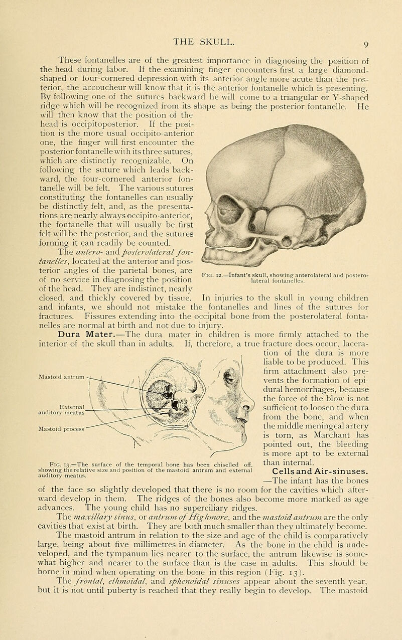 These fontanelles are of the greatest importance in diagnosing the position of the head during labor. If the examining finger encounters first a large diamond- shaped or four-cornered depression with its anterior angle more acute than the pos- terior, the accoucheur will know that it is the anterior fontanelle which is presenting. By following one of the sutures backward he will come to a triangular or Y-shaped ridge which will be recognized from its shape as being the posterior fontanelle. He will then know that the position of the head is occipitoposterior. If the posi- tion is the more usual occipito-anterior one, the finger will first encounter the posterior fontanelle with its three sutures, which are distinctly recognizable. On following the suture which leads back- ward, the four-cornered anterior fon- tanelle will be felt. The various sutures constituting the fontanelles can usually be distinctly felt, and, as the presenta- tions are nearly always occipito-anterior, the fontanelle that will usually be first felt will be the posterior, and the sutures forming it can readily be counted. The antcro- 3,r\A posterolateral/o7i- tanelles, located at the anterior and pos- terior angles of the parietal bones, are of no service in diagnosing the position of the head. They are indistinct, nearly closed, and thickly covered by tissue. In injuries to the skull in young children and infants, we should not mistake the fontanelles and lines of the sutures for fractures. Fissures e.xtending into the occipital bone from the posterolateral fonta- nelles are normal at birth and not due to injury. Dura Mater.—The dura mater in children is more firmly attached to the interior of the skull than in adults. If, therefore, a true fracture does occur, lacera- tion of the dura is more liable to be produced. This firm attachment also pre- vents the formation of epi- dural hemorrhages, because the force of the blow is not sufficient to loosen the dura from the bone, and when the middle meningeal artery is torn, as Marchant has pointed out, the bleeding is more apt to be external than internal. Cells and Air-sinuses. —The infant has the bones of the face so slightly developed that there is no room for the cavities which after- ward develop in them. The ridges of the bones also become more marked as age advances. The young child has no superciliary ridges. The maxillary sums, or antrum of Highmore, and the mastoid antrum are the only cavities that exist at birth. They are both much smaller than they ultimately become. The mastoid antrum in relation to the size and age of the child is comparatively large, being about five milHmetres in diameter. As the bone in the child is unde- veloped, and the tympanum lies nearer to the surface, the antrum likewise is some- what higher and nearer to the surface than is the case in adults. This should be borne in mind when operating on the bone in this region (Fig. 13). The frontal, ethmoidal, and sphetioidal sinuses appear about the seventh )'ear, but it is not until puberty is reached that they really begin to develop. The mastoid auditory meatus Mastoid process Fig. 13.—The surface of the temporal bone has been chiselled off, showing the relative size and position of the mastoid antrum and external auditory meatus.