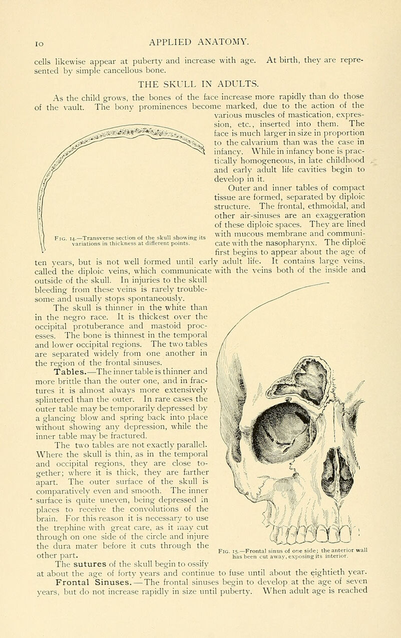 cells likewise appear at pubert)- and increase with age. At birth, they are repre- sented b\^ simple cancellous bone. THE SKULL IN ADULTS. As the child grows, the bones of the face increase more rapidly than do those of the vault. The bony prominences become marked, due to the action of the various muscles of mastication, expres- sion, etc., inserted into them. The face is much larger in size in proportion to the cah'arium than was the case in infancy. While in infancy bone is prac- tically homogeneous, in late childhood and early adult life cavities begin to develop in it. Outer and inner tables of compact tissue are formed, separated by diploic structure. The frontal, ethmoidal, and other air-sinuses are an exaggeration of these diploic spaces. They are lined with mucous membrane and communi- cate with the nasopharynx. The diploe first begins to appear about the age of ten years, but is not well formed until early adult life. It contains large veins, called the diploic veins, which communicate with the veins both of the inside and outside of the skull. In injuries to the skull bleeding from these veins is rarely trouble- some and usually stops spontaneously. The skull is thinner in the white than in the negro race. It is thickest over the occipital protuberance and mastoid proc- esses. The bone is thinnest in the temporal and lower occipital regions. The two tables are separated widely from one another in the region of the frontal sinuses. Tables.—The inner table is thinner and more brittle than the outer one, and in frac- tures it is almost always more extensively splintered than the outer. In rare cases the outer table may be temporarily depressed by a glancing blow and spring back into place without showing any depression, while the inner table may be fractured. The two tables are not exactly parallel. Where the skull is thin, as in the temporal and occipital regions, they are close to- gether; where it is thick, they are farther apart. The outer surface of the skull is comparatively even and smooth. The inner • surface is quite uneven, being depressed in places to receive the convolutions of the brain. For this reason it is necessary to use the trephine with great care, as it ina}' cut through on one side of the circle and injure the dura mater before it cuts through the other part. The sutures of the skull begin to ossify at about the age of forty years and continue to fuse until about the eightieth year. Frontal Sinuses.—The frontal sinuses begin to develop at the age of seven years, but do not increase rapidly in size until puberty. When adult age is reached Frontal sinus of one side; the anterior wall 3een cut away, exposing its interior.