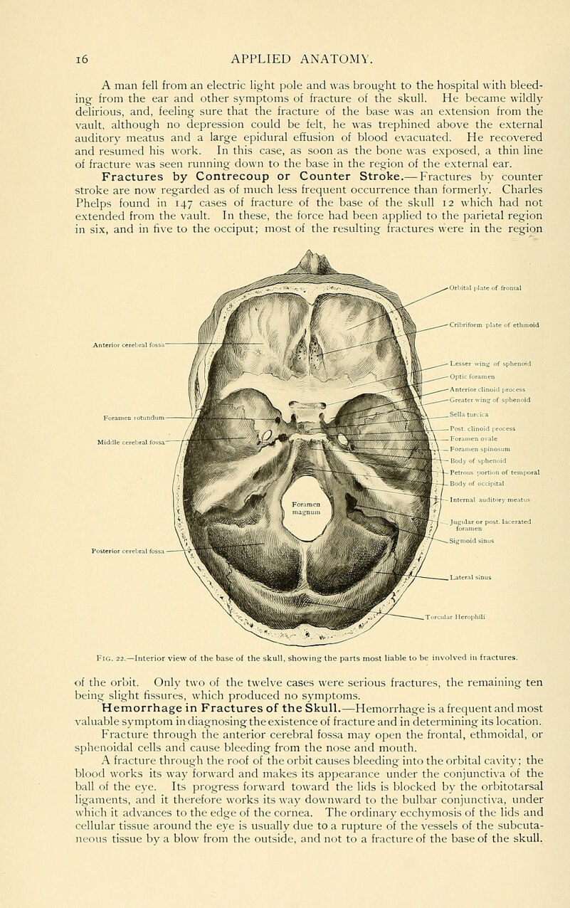 A man fell from an electric light pole and was brought to the hospital with bleed- ing from the ear and other symptoms of fracture of the skull. He became wildly delirious, and, feeling sure that the fracture of the base was an extension from the vault, although no depression could be felt, he was trephined above the external auditory meatus and a large epidural effusion of blood e\'acuated. He recovered and resumed his work. In this case, as soon as the bone was exposed, a thin line of fracture was seen running down to the base in the region of the external ear. Fractures by Contrecoup or Counter Stroke.— Fractures by counter stroke are now regarded as of much less frequent occurrence than formerl)'. Charles Phelps found in 147 cases of fracture of the base of the skull 12 which had not extended from the vault. In these, the force had been applied to the parietal region in six, and in five to the occiput; most of the resulting fractures were in the region Anterior cerebral foSSi ForaiiieD rotund Middle cerebral fos: Posterior cerebral fossa Orliital plate of frontal Cribriform plate of ethir Lesser ing of sphenoid Optic foramen Anterior clinoid process Greater win^ of sphenoid Sella turcica Foramen spinosum Body of sphenoid Petrous portion of tempore Ijody of occipital Internal auditory meatus Jugular or post, lacerated foramen Fig. 22.—Interior view of the base of the skull, showing the parts most liable to be involved in fractures. of the orbit. Only two of the tweh'e cases were serious fractures, the remaining ten being slight fissures, which produced no symptoms. Hemorrhage in Fractures of the Skull.—Hemorrhage is a frequent and most valuable symptom in diagnosing the existence of fracture and in determining its location. Fracture through the anterior cerebral fossa may open the frontal, ethmoidal, or sphenoidal cells and cause bleeding from the nose and mouth. A fracture through the roof of the orbit causes bleeding into the orbital cavity; the blood works its way forward and makes its appearance under the conjunctiva of the ball of the eye. Its progress forward toward the lids is blocked by the orbitotarsal ligaments, and it therefore works its way downward to the bulbar conjunctiva, under which it advances to the edge of the cornea. The ordinary ecchymosis of the lids and cellular tissue around the eye is usually due to a rupture of the vessels of the subcuta- neous tissue by a blow from the outside, and not to a fracture of the base of the skull.