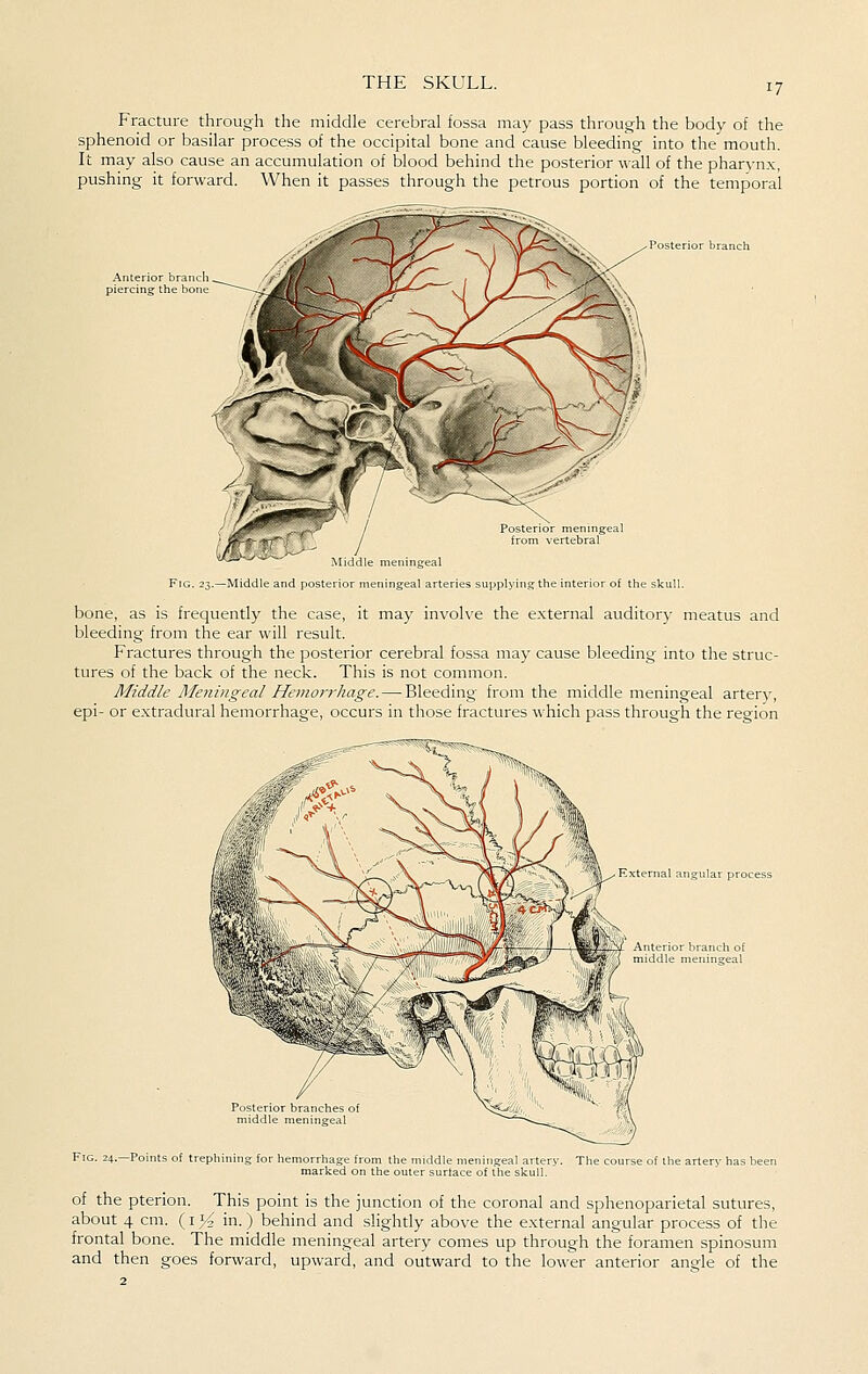 Fracture through the middle cerebral fossa may pass through the body of the sphenoid or basilar process of the occipital bone and cause bleeding into the mouth. It may also cause an accumulation of blood behind the posterior wall of the pharynx, pushing it forward. When it passes through the petrous portion of the temporal Anterior brand piercing the bom Posterior branch Fig. 23.—Middle and poster: lingeal arteries supplying the interior of the skull. bone, as is frequently the case, it may involve the external auditory meatus and bleeding from the ear will result. Fractures through the posterior cerebral fossa may cause bleeding into the struc- tures of the back of the neck. This is not common. Middle Meni)igeal Hemor7'hage.—Bleeding from the middle meningeal artery, epi- or extradural hemorrhage, occurs in those fractures which pass through the region paternal angular process Fig. 24.—Points of trephin The course of the artery has been of the pterion. This point is the junction of the coronal and sphenoparietal sutures, about 4 cm. (i J^ in.) behind and slighdy above the external angular process of the frontal bone. The middle meningeal artery comes up through the foramen spinosum and then goes forward, upward, and outward to the lower anterior angle of the
