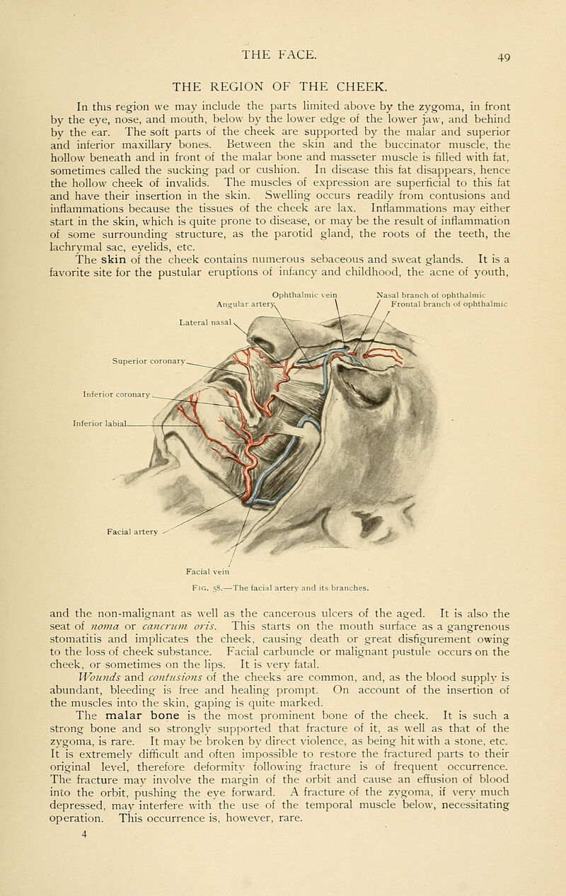 THE REGION OF THE CHEEK. In this region we may include the parts limited above by the zygoma, in front by the eye, nose, and mouth, below by the lower edge of the lower jaw, and behind by the ear. The soft parts of the cheek are supported by the malar and superior and inferior maxillary bones. Between the skin and the buccinator muscle, the hollow beneath and in front of the malar bone and masseter muscle is filled with fat, sometimes called the sucking pad or cushion. In disease this fat disappears, hence the hollow cheek of invalids. The muscles of expression are superficial to this fat and have their insertion in the skin. Swelling occurs readily from contusions and inflammations because the tissues of the cheek are lax. Inflammations may either start in the skin, which is quite prone to disease, or may be the result of inflammation of some surrounding structure, as the parotid gland, the roots of the teeth, the lachrymal sac, eyelids, etc. The skin of the cheek contains numerous sebaceous and sweat glands. It is a favorite site for the pustular eruptions of infancy and childhood, the acne of youth, Angul; Lateral nasal Nasal branch of ophthalmic Frontal branch of ophthaln Superior coronary Inferior coronary ^^__/''^ Inferior labial. Facial artery Facial ^ Fig. ■■ -The facial artery and its branches. and the non-malignant as well as the cancerous ulcers of the aged. It is also the seat of 7ioma or cancriim oi-is. This starts on the mouth surface as a gangrenous stomatitis and implicates the cheek, causing death or great disfigurement owing to the loss of cheek substance. Facial carbuncle or malignant pustule occurs on the cheek, or sometimes on the lips. It is very fatal. Wounds and contusions of the cheeks are common, and, as the blood supplv is abundant, bleeding is free and healing prompt. On account of the insertion of the muscles into the skin, gaping is quite marked. The malar bone is the most prominent bone of the cheek. It is such a strong bone and so strongly supported that fracture of it, as well as that of the zygoma, is rare. It may be broken by direct violence, as being hit with a stone, etc. It is extremely difficult and often impossible to restore the fractured parts to their original level, therefore deformity following fracture is of frequent occurrence. The fracture may involve the margin of the orbit and cause an efTusion of blood into the orbit, pushing the eye forward. A fracture of the zygoma, if \'ery much depressed, may interfere with the use of the temporal muscle below, necessitating operation. This occurrence is, however, rare.