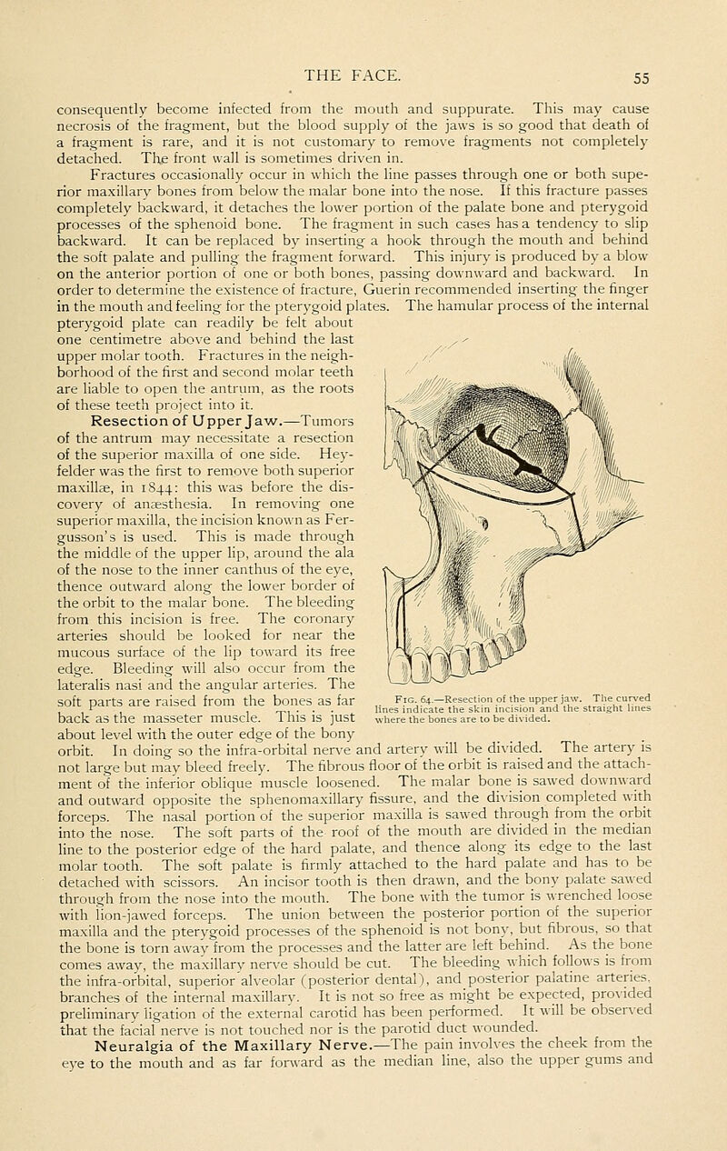 consequently become infected from the mouth and suppurate. This may cause necrosis of the fragment, but the blood supply of the jaws is so good that death of a fragment is rare, and it is not customary to remove fragments not completely detached. The front wall is sometimes driven in. Fractures occasionally occur in which the line passes through one or both supe- rior maxillary bones from below the malar bone into the nose. If this fracture passes completely backward, it detaches the lower portion of the palate bone and pterygoid processes of the sphenoid bone. The fragment in such cases has a tendency to slip backward. It can be replaced by inserting a hook through the mouth and behind the soft palate and pulling the fragment forward. This injury is produced by a blow on the anterior portion of one or both bones, passing downward and backward. In order to determine the existence of fracture, Guerin recommended inserting the finger in the mouth and feeling for the pterygoid plates. The hamular process of the internal pterygoid plate can readily be felt about one centimetre above and behind the last ^ ^ upper molar tooth. Fractures in the neigh- borhood of the first and second molar teeth are liable to open the antrum, as the roots of these teeth project into it. Resection of Upper Jaw.—Tumors of the antrum may necessitate a resection of the superior ma.xilla of one side. Hey- felder was the first to remove both superior maxillse, in 1844: this was before the dis- covery of anaesthesia. In removing one superior maxilla, the incision known as Fer- gusson's is used. This is made through the middle of the upper lip, around the ala of the nose to the inner canthus of the eye, thence outward along the lower border of the orbit to the malar bone. The bleeding from this incision is free. The coronary arteries should be looked for near the mucous surface of the lip toward its free edge. Bleeding will also occur from the lateralis nasi and the angular arteries. The soft parts are raised from the bones as far back as the masseter muscle. This is just about level with the outer edge of the bony orbit. In doing so the infra-orbital nerve and artery will be divided. The artery is not large but may bleed freely. The fibrous floor of the orbit is raised and the attach- ment of the inferior oblique muscle loosened. The malar bone is sawed downward and outward opposite the sphenomaxillary fissure, and the division completed with forceps. The nasal portion of the superior maxilla is sawed through from the orbit into the nose. The soft parts of the roof of the mouth are divided in the median line to the posterior edge of the hard palate, and thence along its edge to the last molar tooth. The soft palate is firmly attached to the hard palate and has to be detached with scissors. An incisor tooth is then drawn, and the bony palate sawed through from the nose into the mouth. The bone with the tumor is wrenched loose with lion-jawed forceps. The union between the posterior portion of the superior maxilla and the pterygoid processes of the sphenoid is not bony, but fibrous, so that the bone is torn awav from the processes and the latter are left behind. As the bone comes awav, the maxillarv ner^^e should be cut. The bleeding which follows is from the infra-orbital, superior'alveolar (posterior dental), and posterior palatine arteries, branches of the internal maxillary. It is not so free as might be expected, provided preliminary ligation of the external carotid has been performed. It will be observed that the facial nerve is not touched nor is the parotid duct wounded. Neuralgia of the Maxillary Nerve.—The pain involves the cheek from the eye to the mouth and as far forward as the median line, also the upper gums and Fig. 64.—Resection of the upper jaw. The curved lines indicate the skin incision and the straight lines where the bones are to be divided.